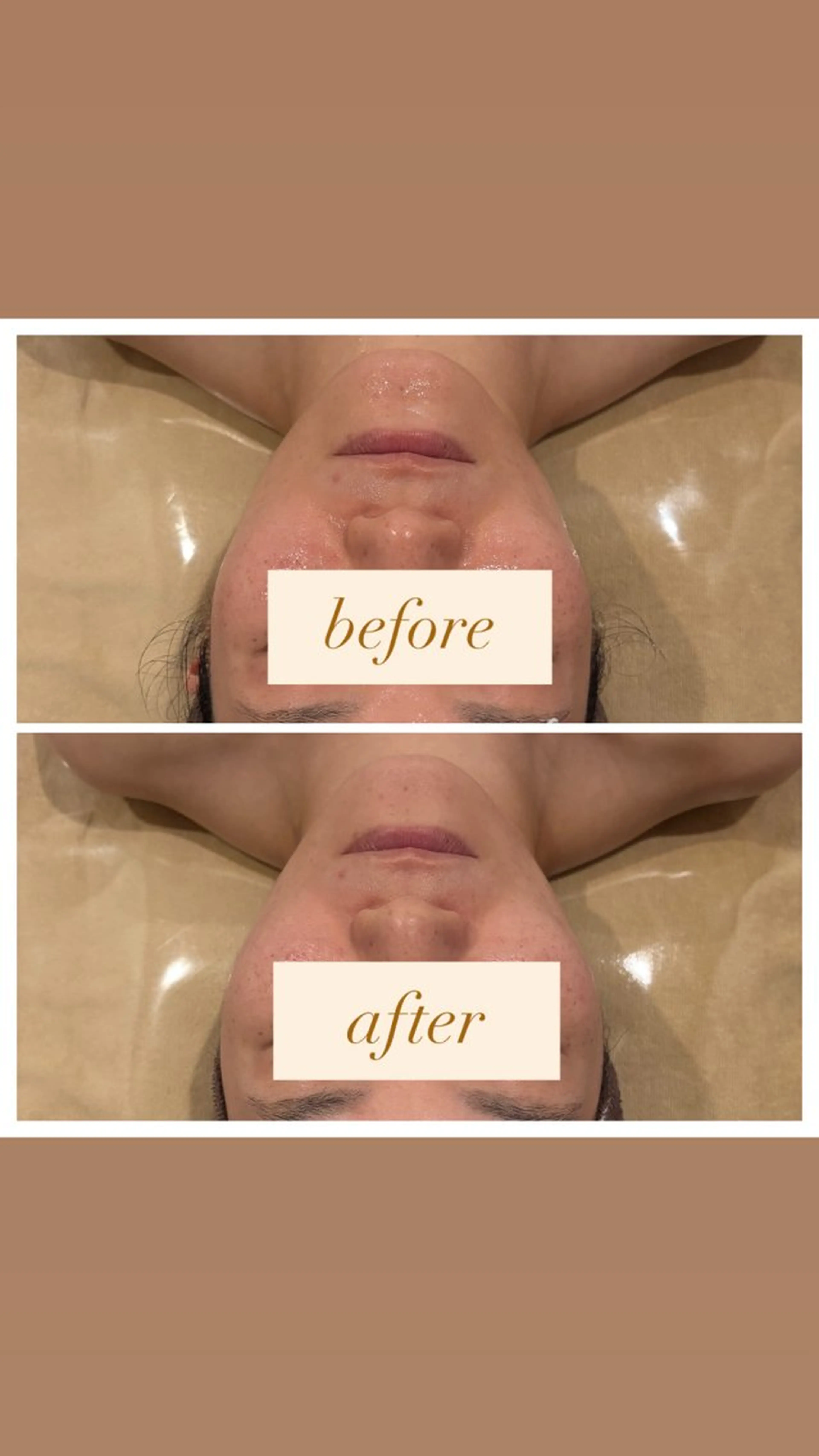 【3月限定🄼🄴🄽🅄🌿】 小顔EX×小顔コルギ×毛穴洗浄🌼の写真