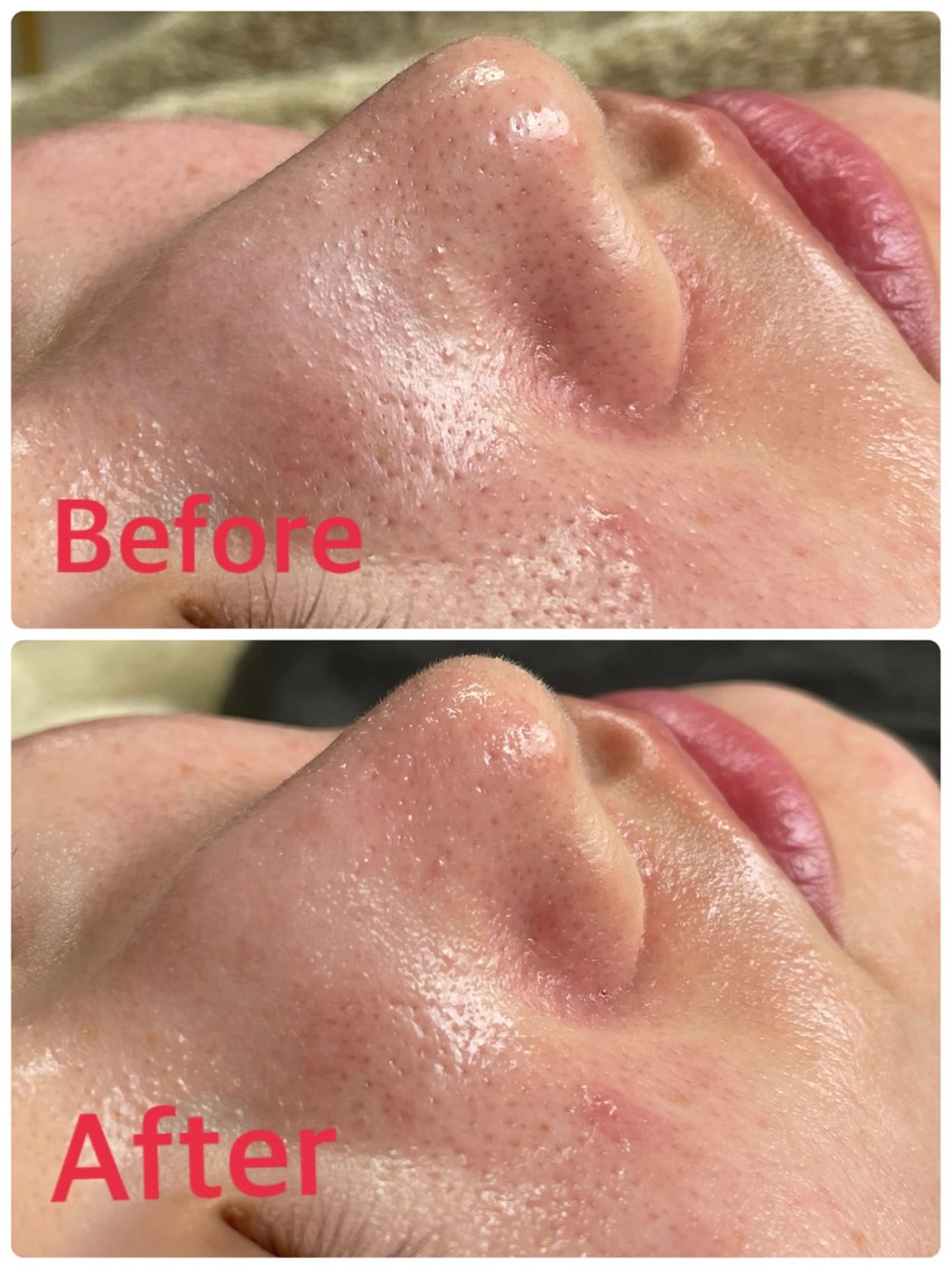 口コミ限定価格🌟毛穴洗浄!(しつこい黒ずみ、毛穴汚れなどを綺麗にします)🫶🏻の写真