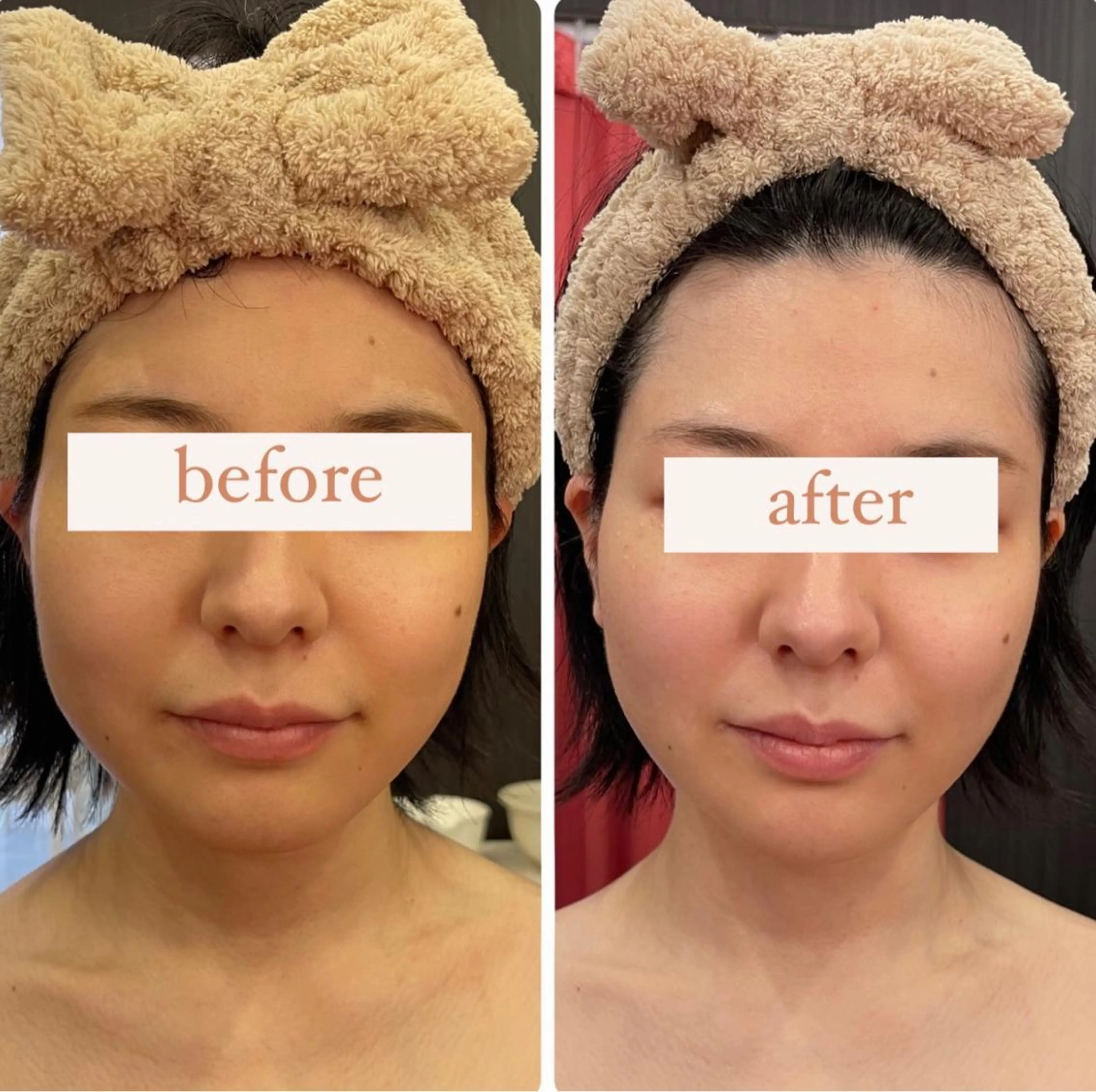 超高機能美容液(ヒト神経幹細胞順化培養液)を気になるところにスプレーするだけ。1分で激変!!印象アップデート完了🤫の写真