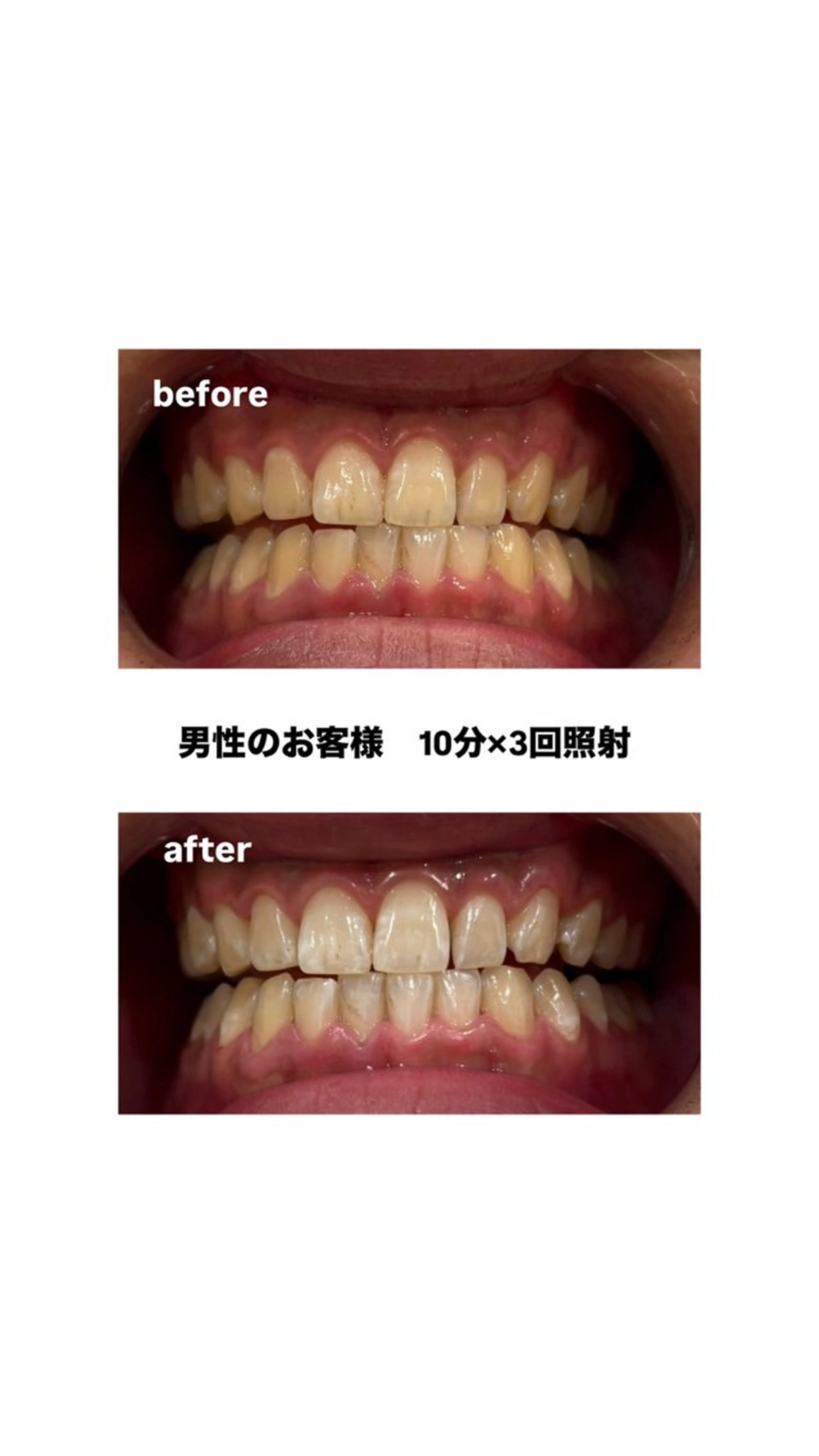 歯のセルフホワイトニング​〜​期間限定価格！の写真