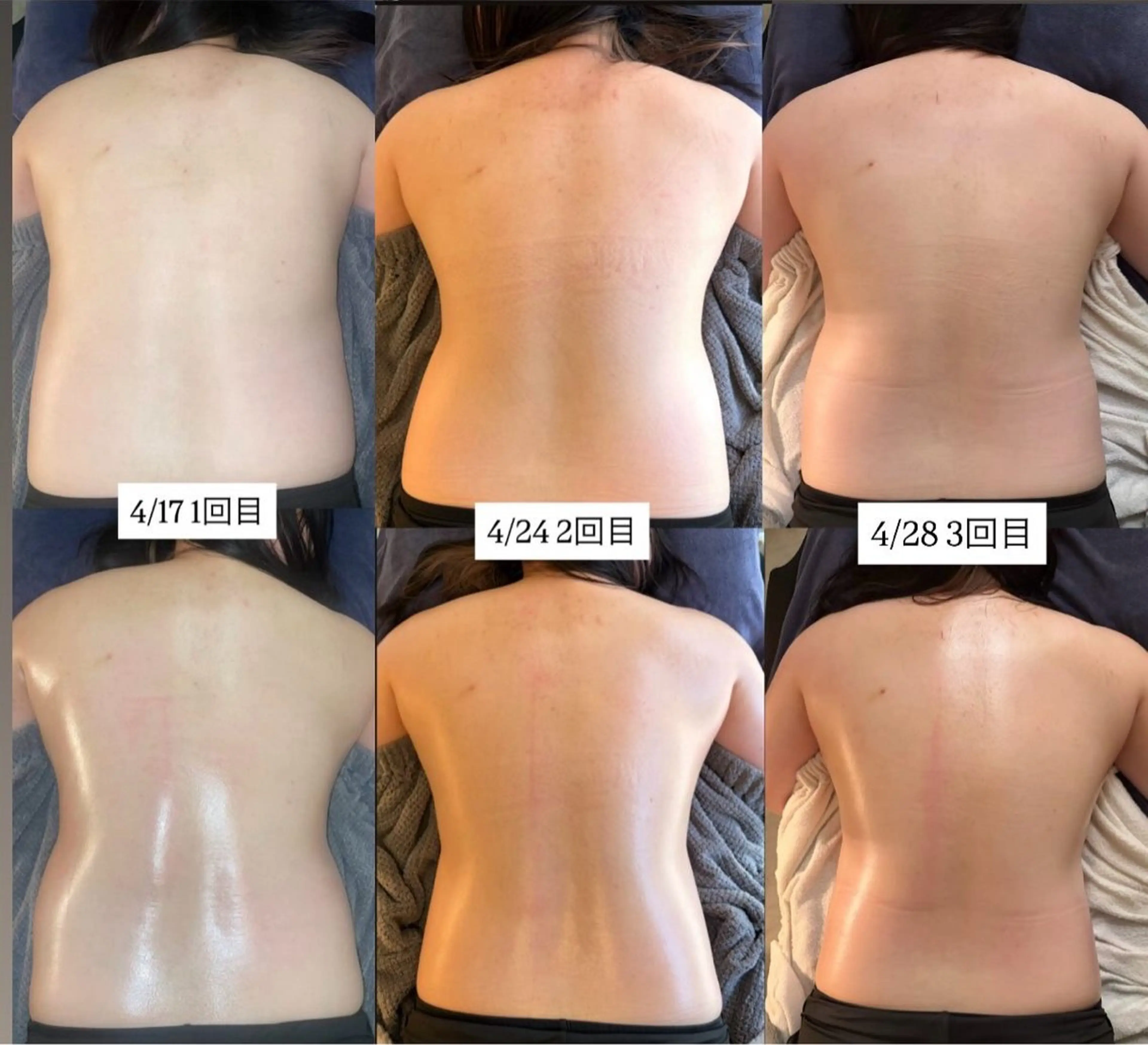 初回限定🌿背中痩身エステの写真