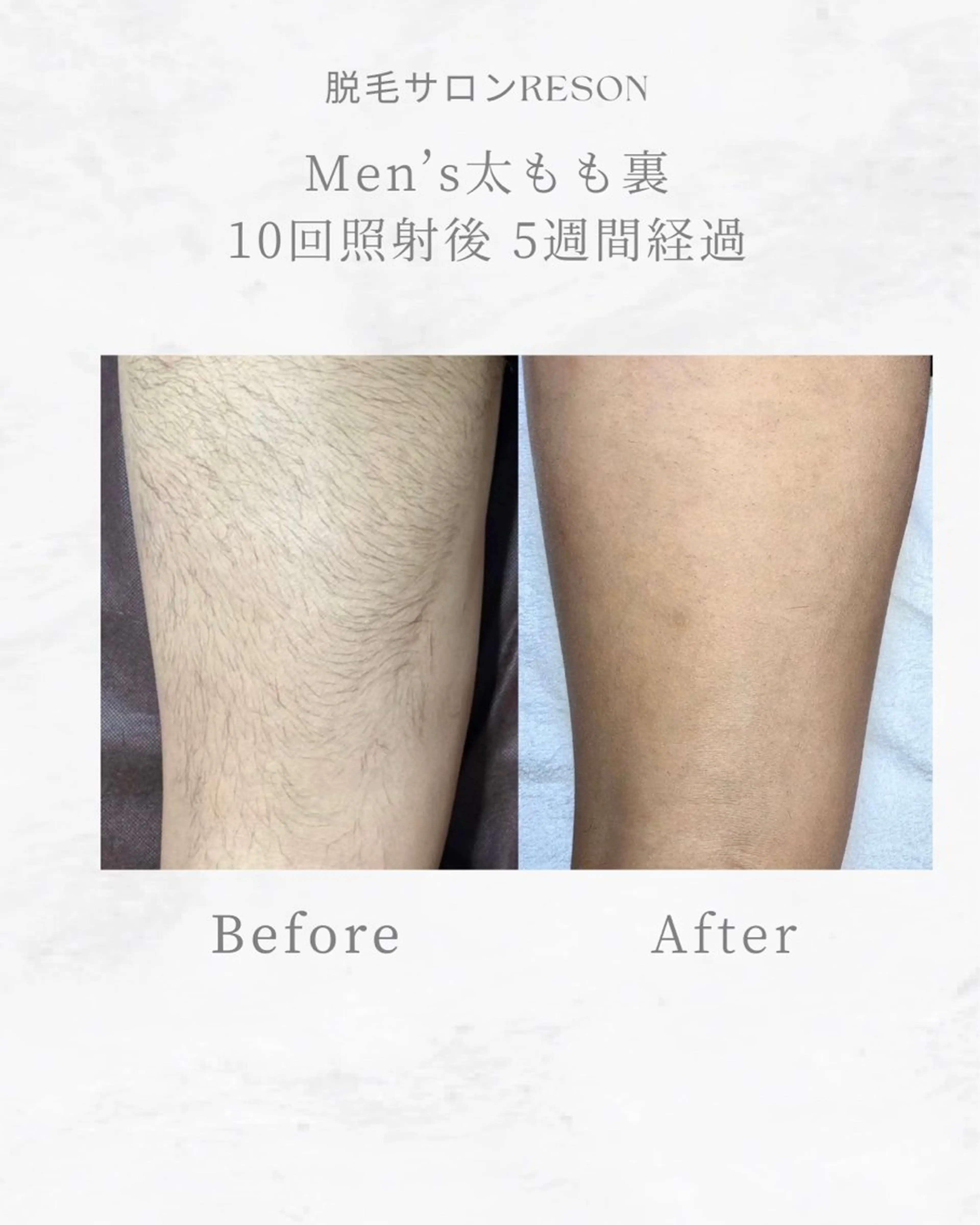 メンズ 都度払いの脱毛サロン RESONのエステ・リラクイメージ