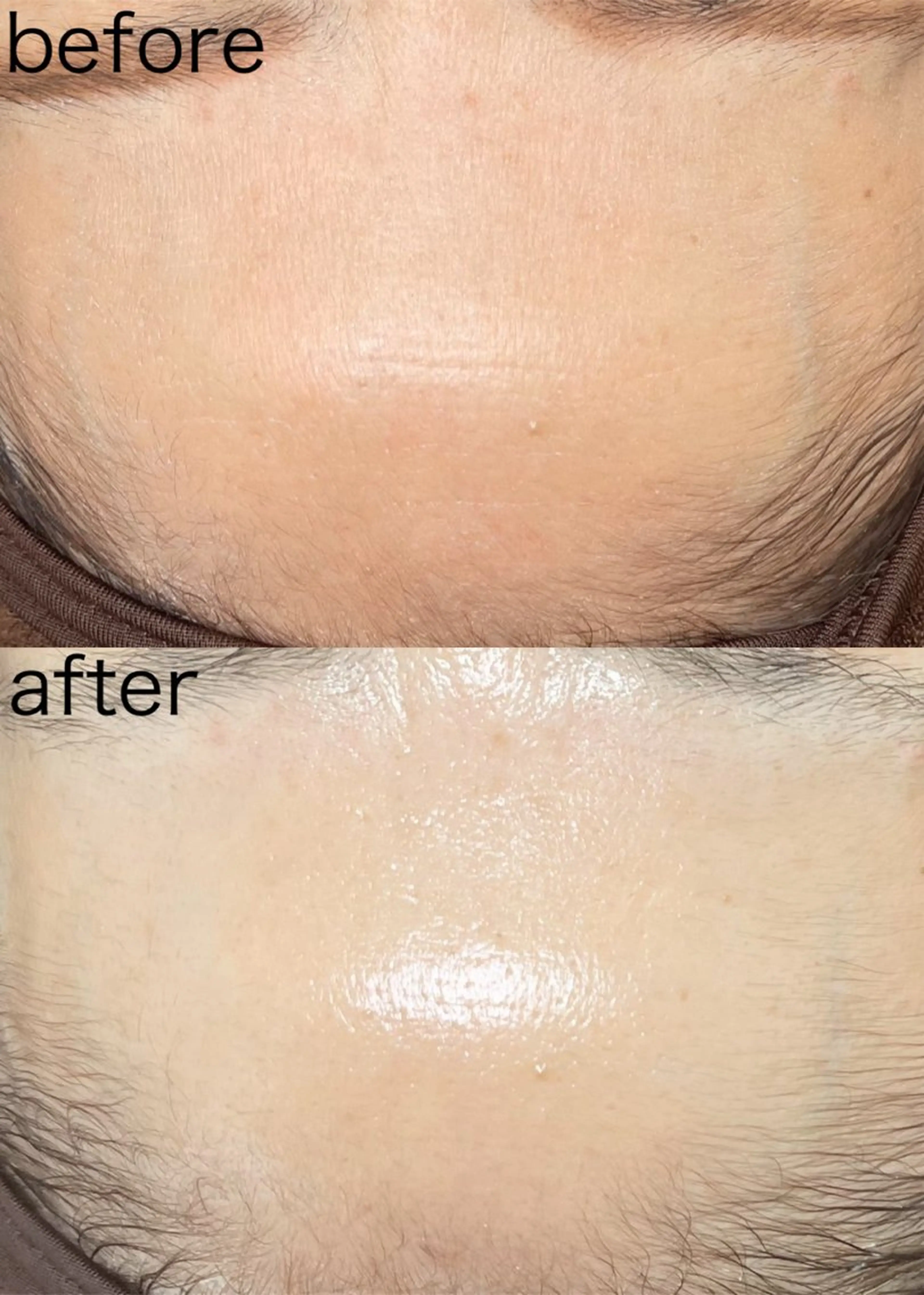 【アトピー肌・超敏感肌🙆‍♀️】LAMI PEELコース☆ラミネートした様な艶肌への写真