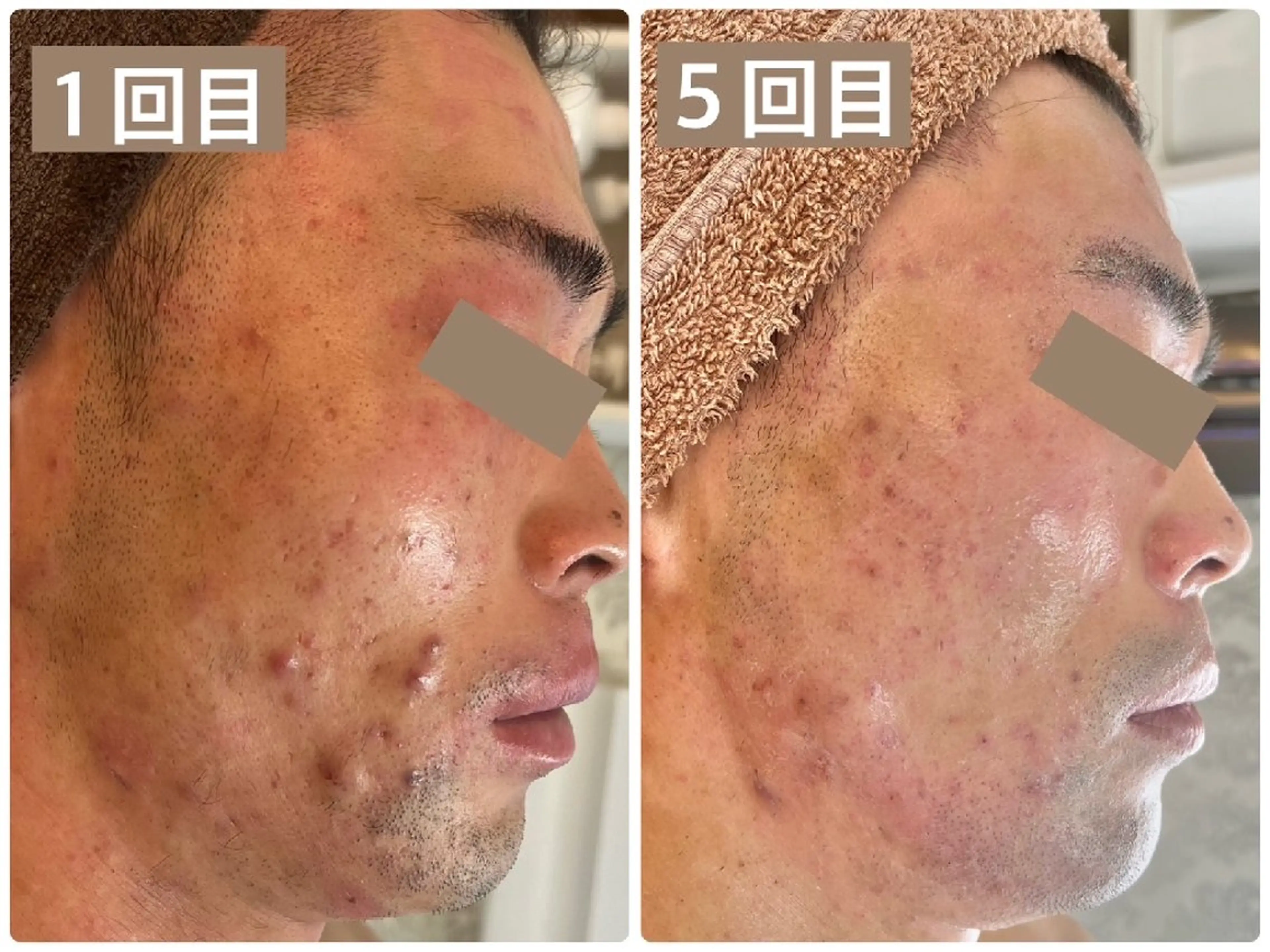 エステ Sha.Lu.Lu.所属・本気の肌質改善/ ハーブピーリングのエステ・リラクイメージ