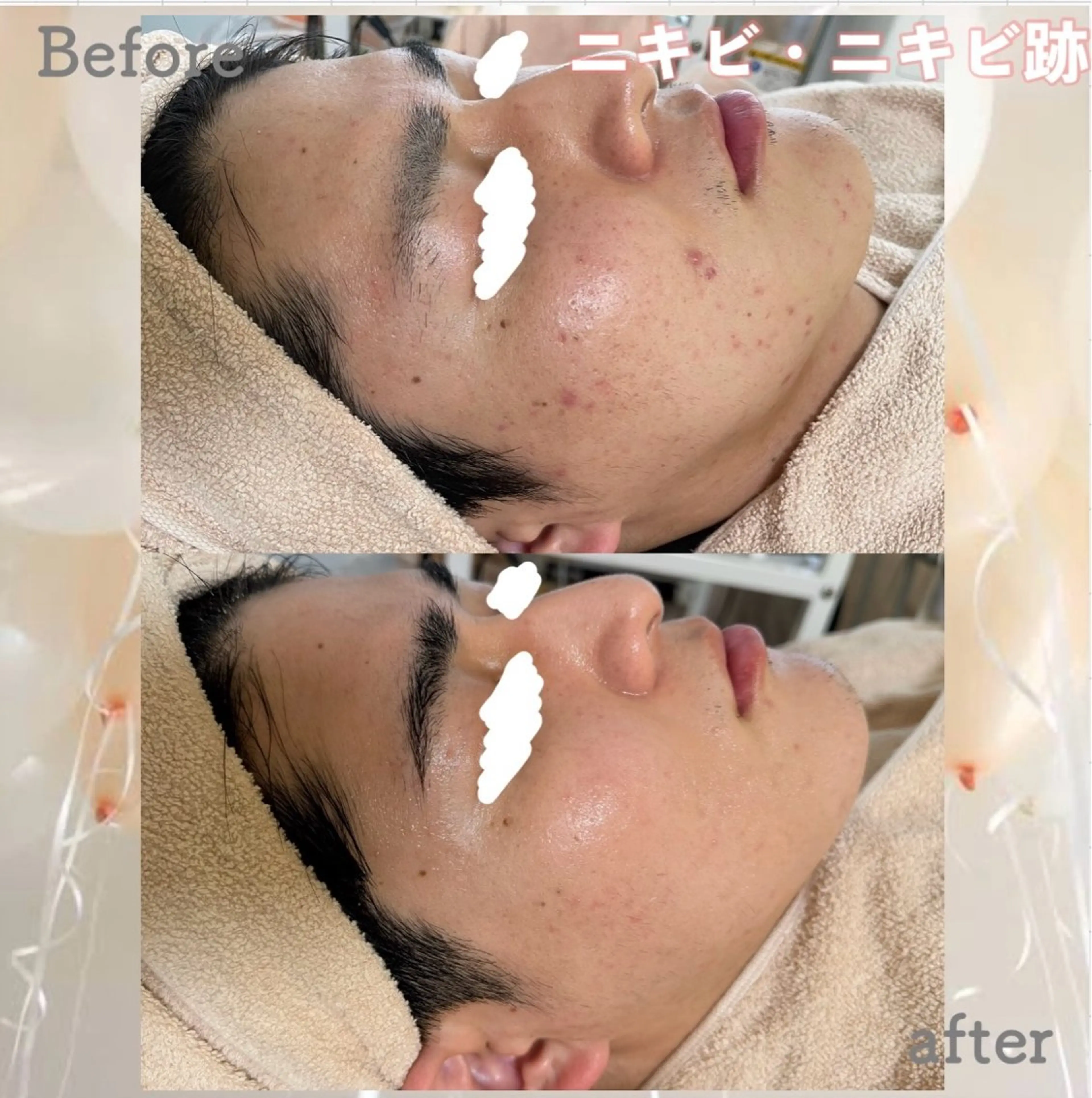 エステ ニキビ&跡改善サロン オーナー光木のエステ・リラクイメージ