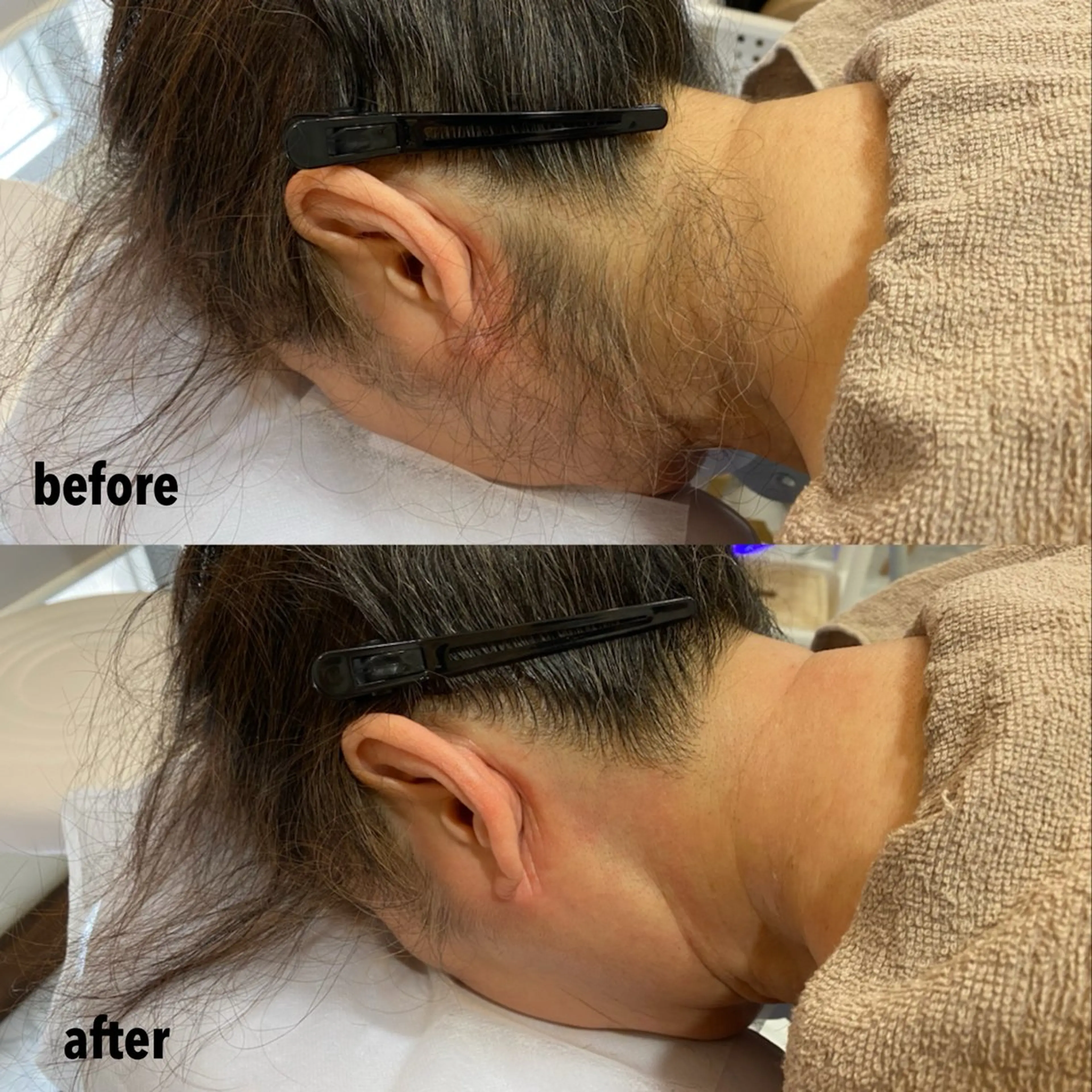 【脱毛2箇所】{顔・うなじ・お腹・背中・両腕・両足}お好きな箇所をお選びいただけます✨✨の写真