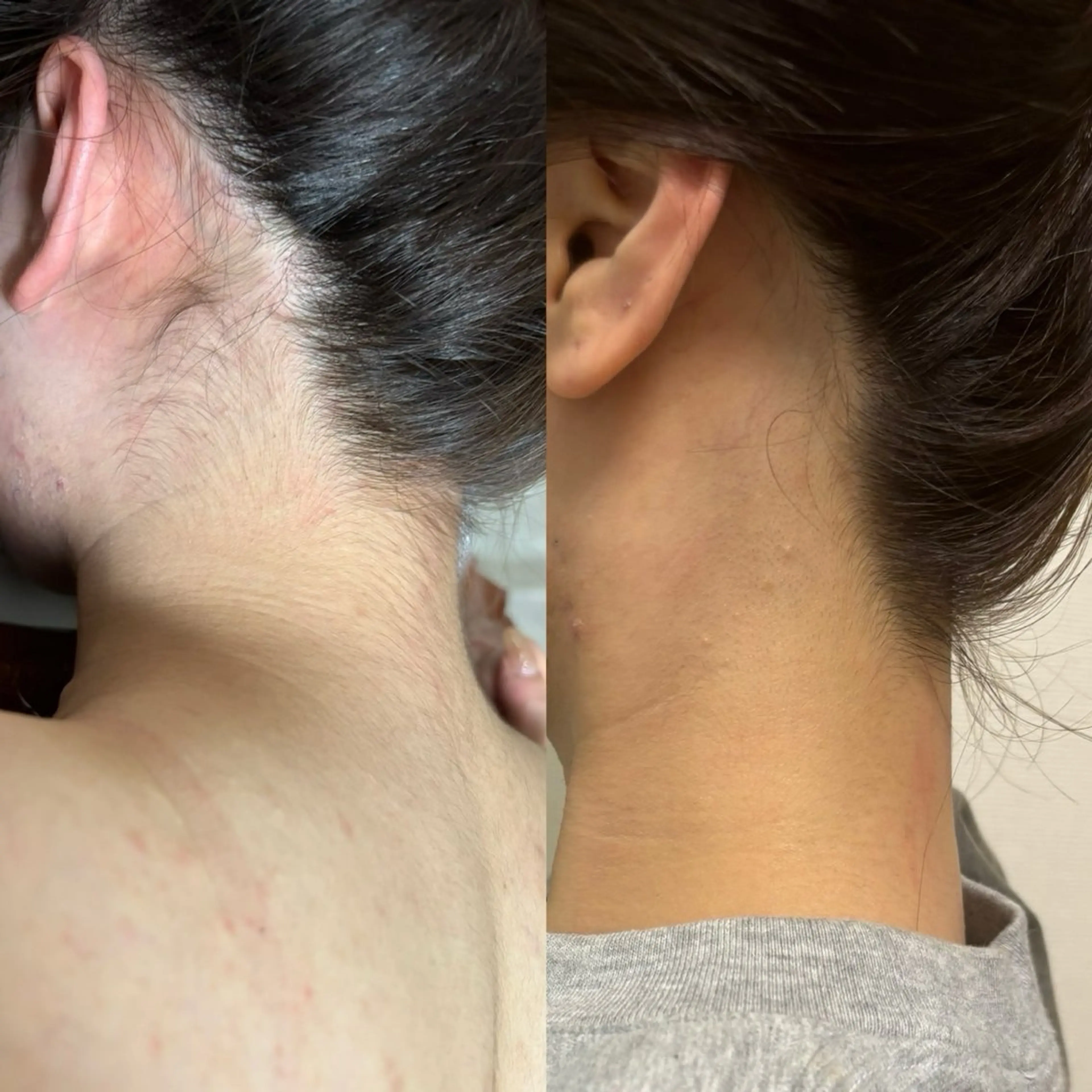 脱毛 Linomalie エステ/たるみ/脱毛のエステ・リラクイメージ