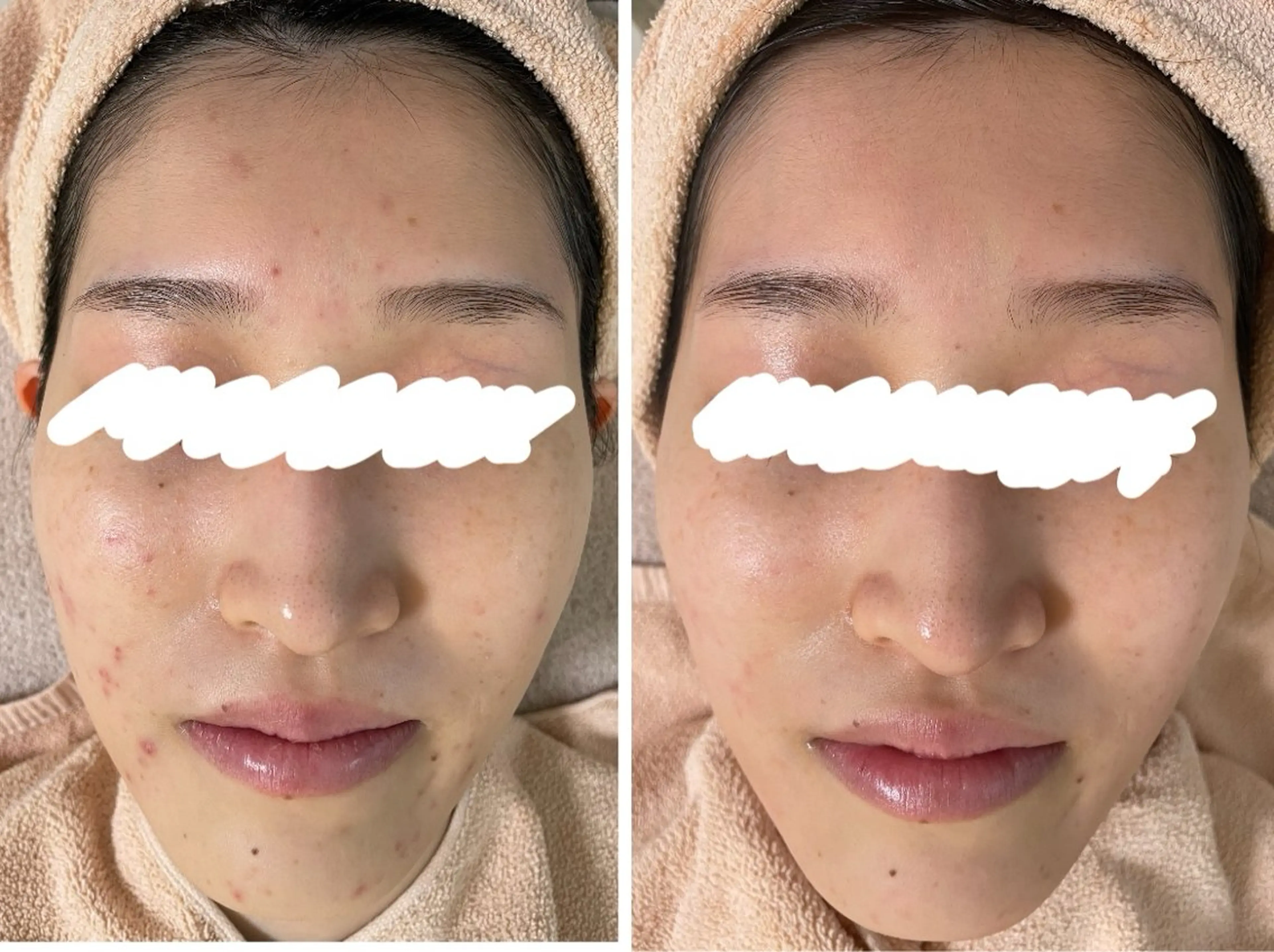 エステ ニキビ&跡改善サロン オーナー光木のエステ・リラクイメージ