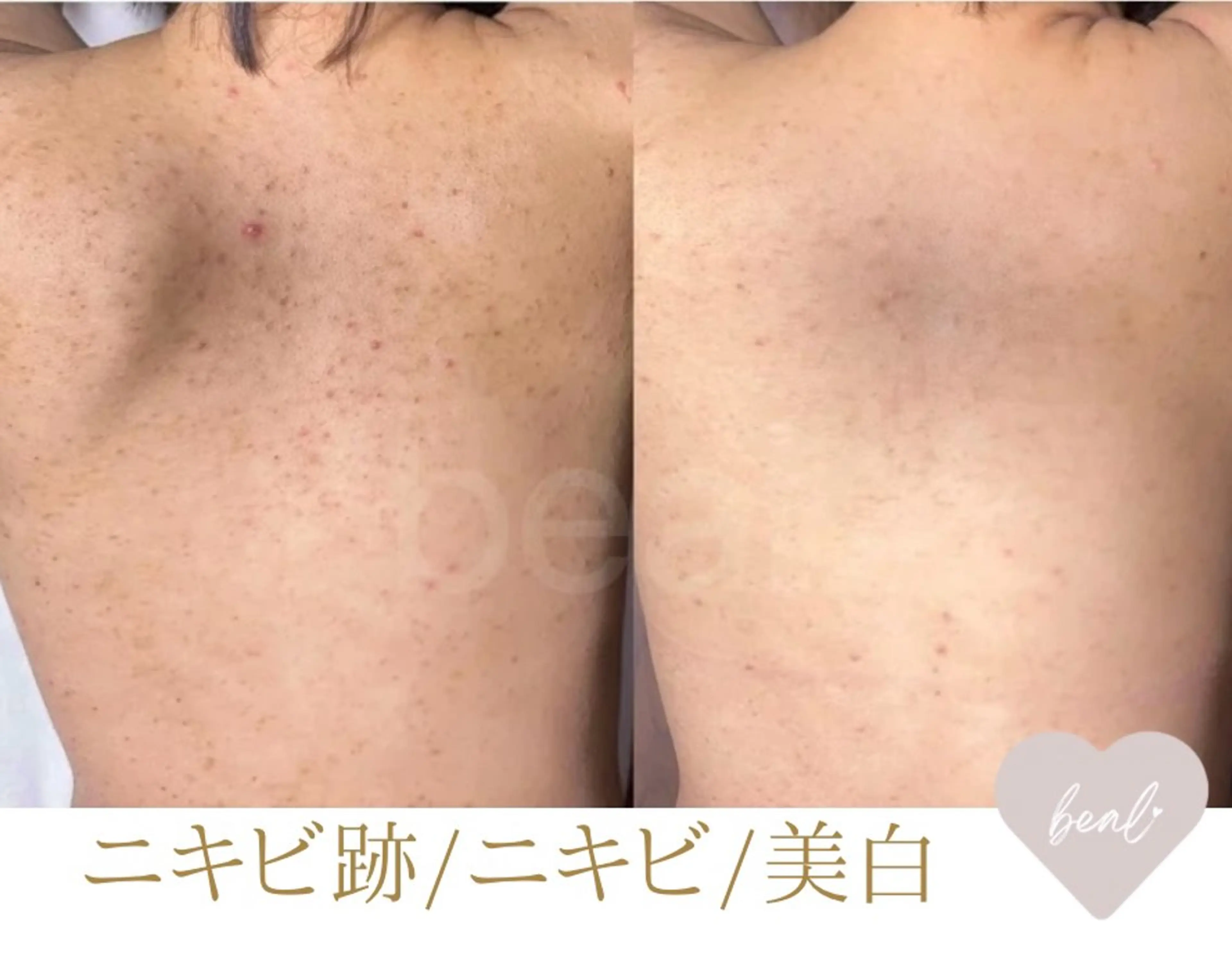 残り2名背中ニキビケア/跡】上半分/最高級★剥離有ハーブピーリング¥60000→の写真