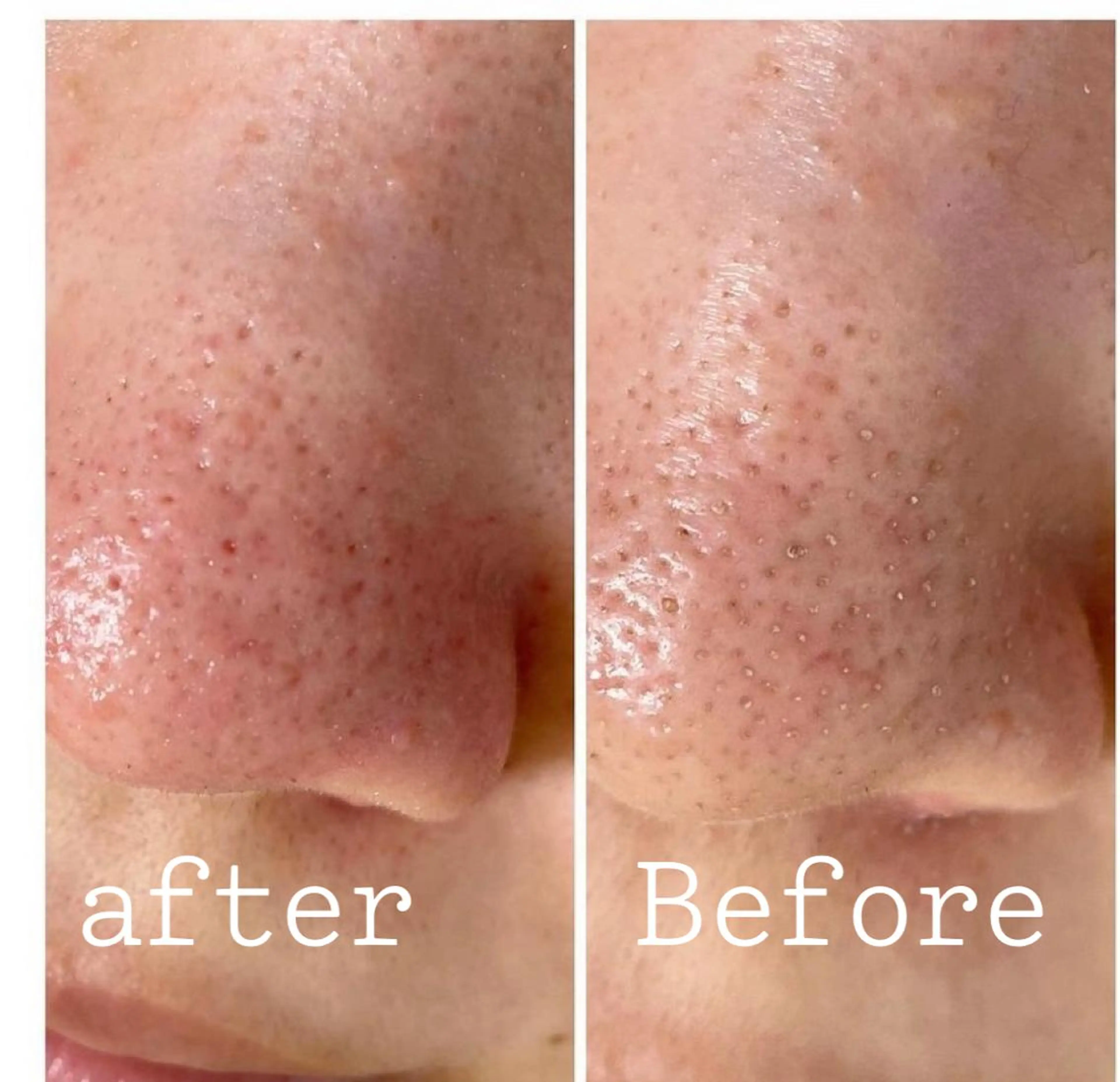 【頑固鼻の黒ずみ、角栓の毛穴洗浄】毛穴エクストラクション＋細胞修復機械✨の写真