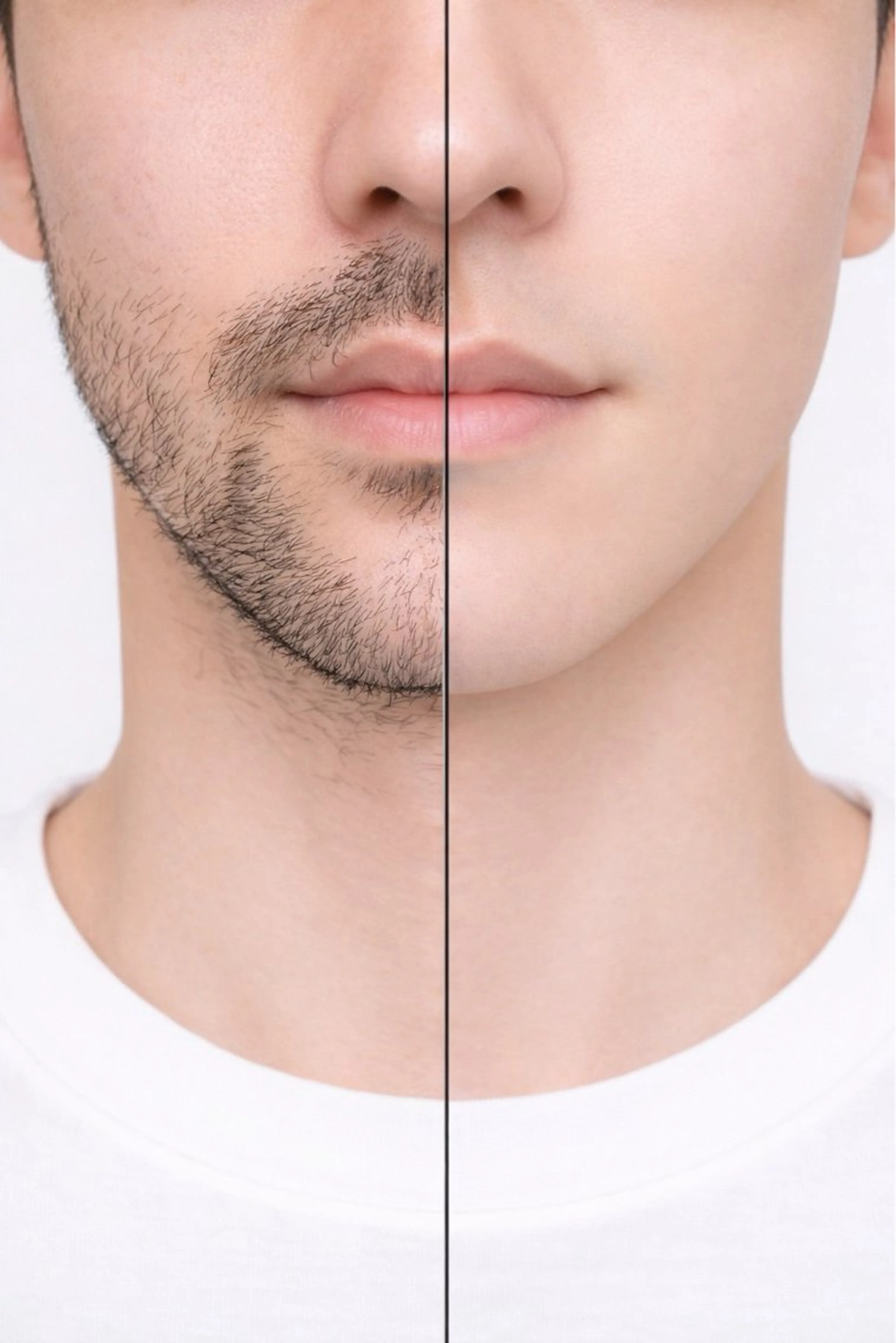 ヒゲ5点脱毛（頬、鼻下、顎、首周り、もみあげ）の写真