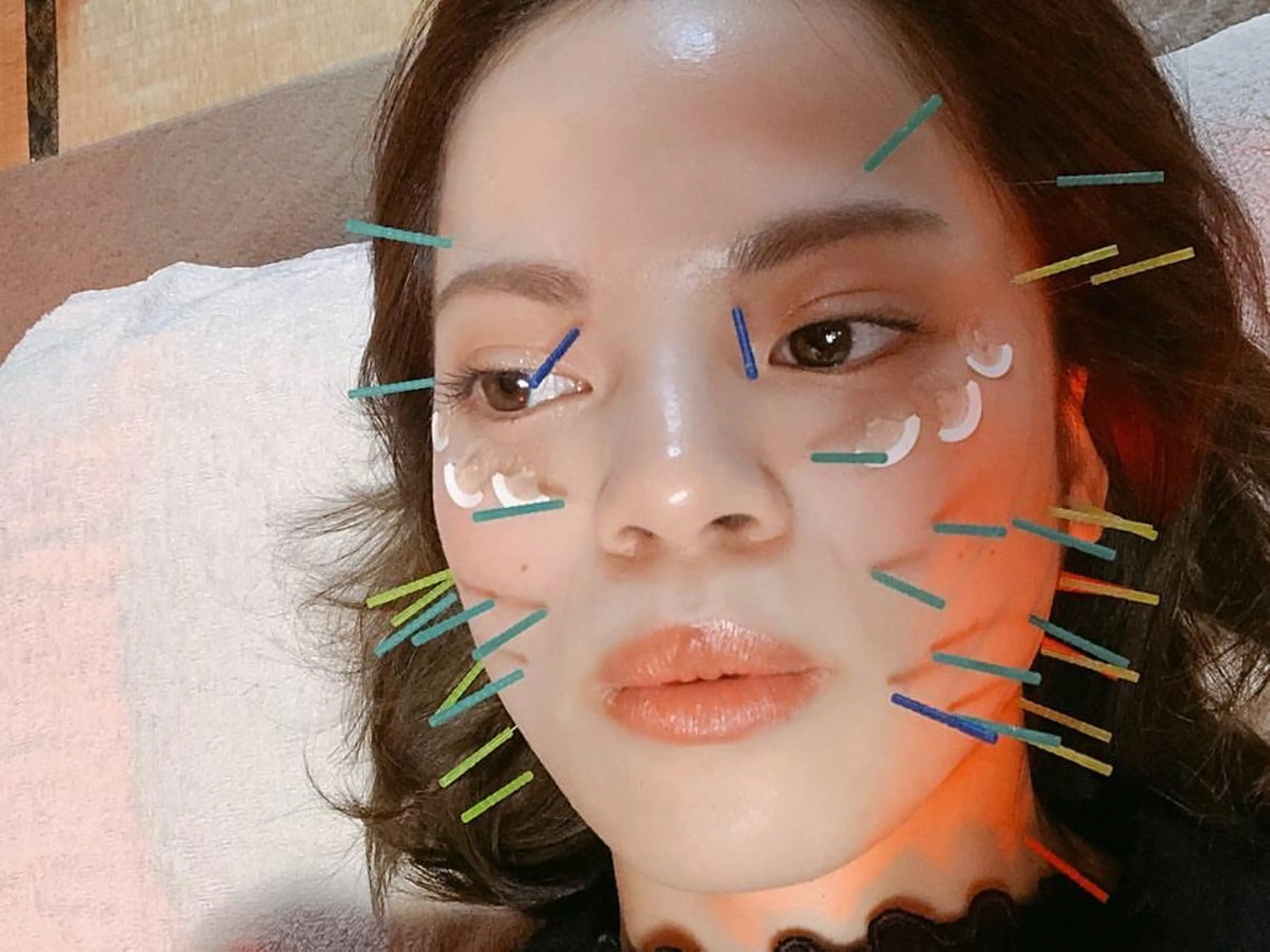 小顔効果抜群！美容鍼＋小顔整体コースの写真