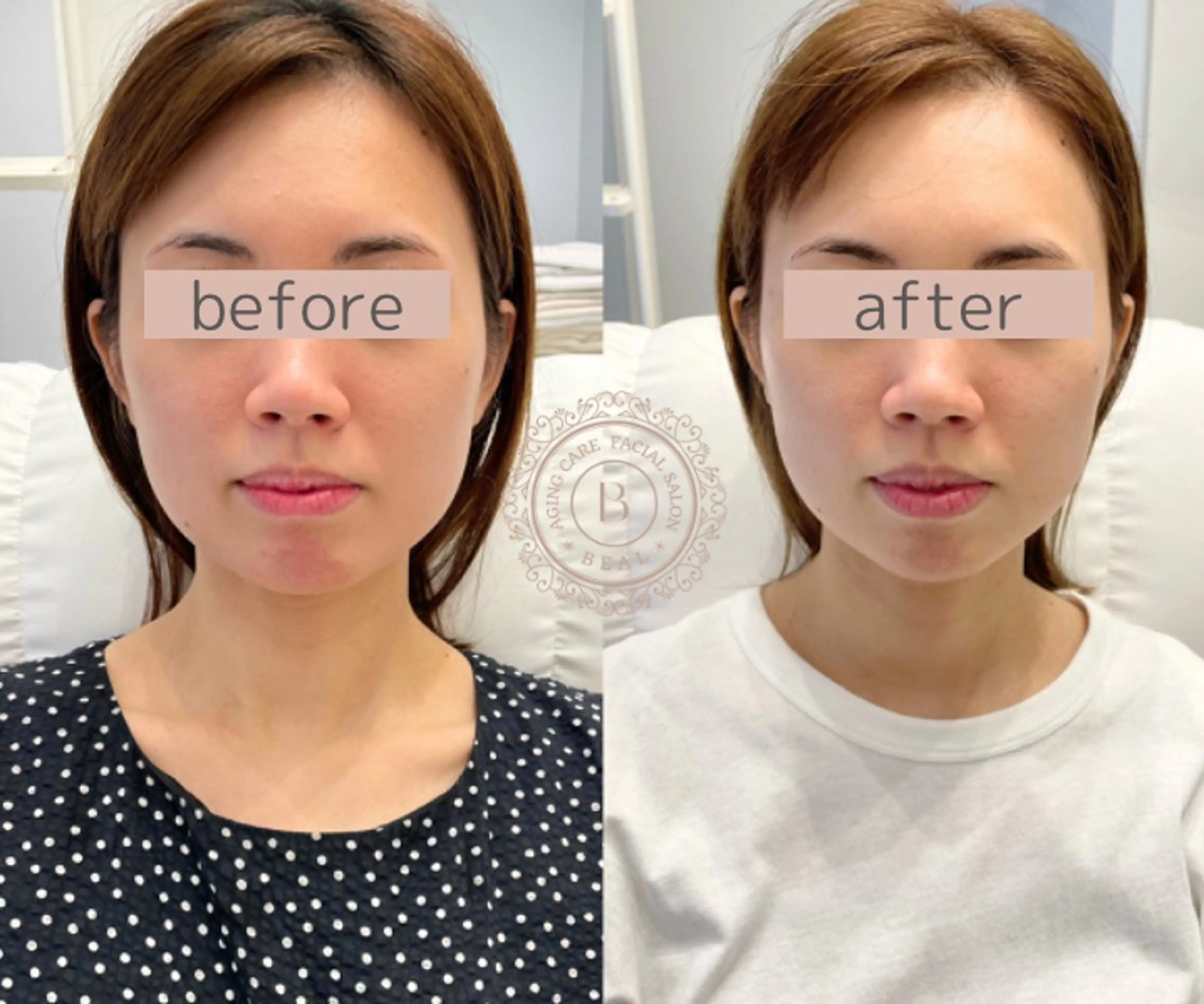 即効性ブライダルケア🤍小顔矯正&剥離なしハーブピーリング💆♀️¥33,000→の写真