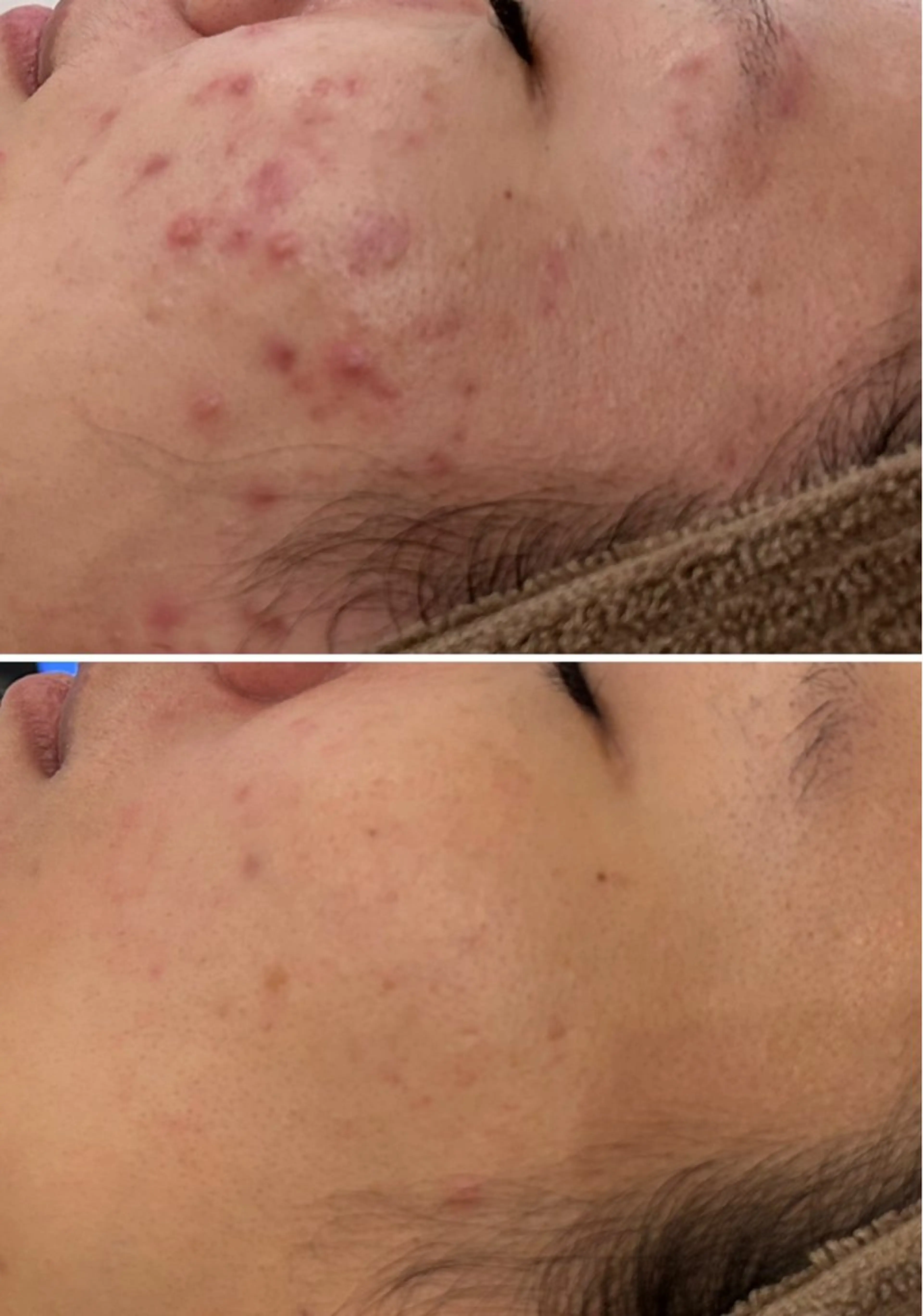 【1名様】卒ニキビしたい方チャンス❣️2万円以上の施術😆SNS写真掲載OKな方！2週​〜​3週間に1度最低3ヶ月通える方の写真