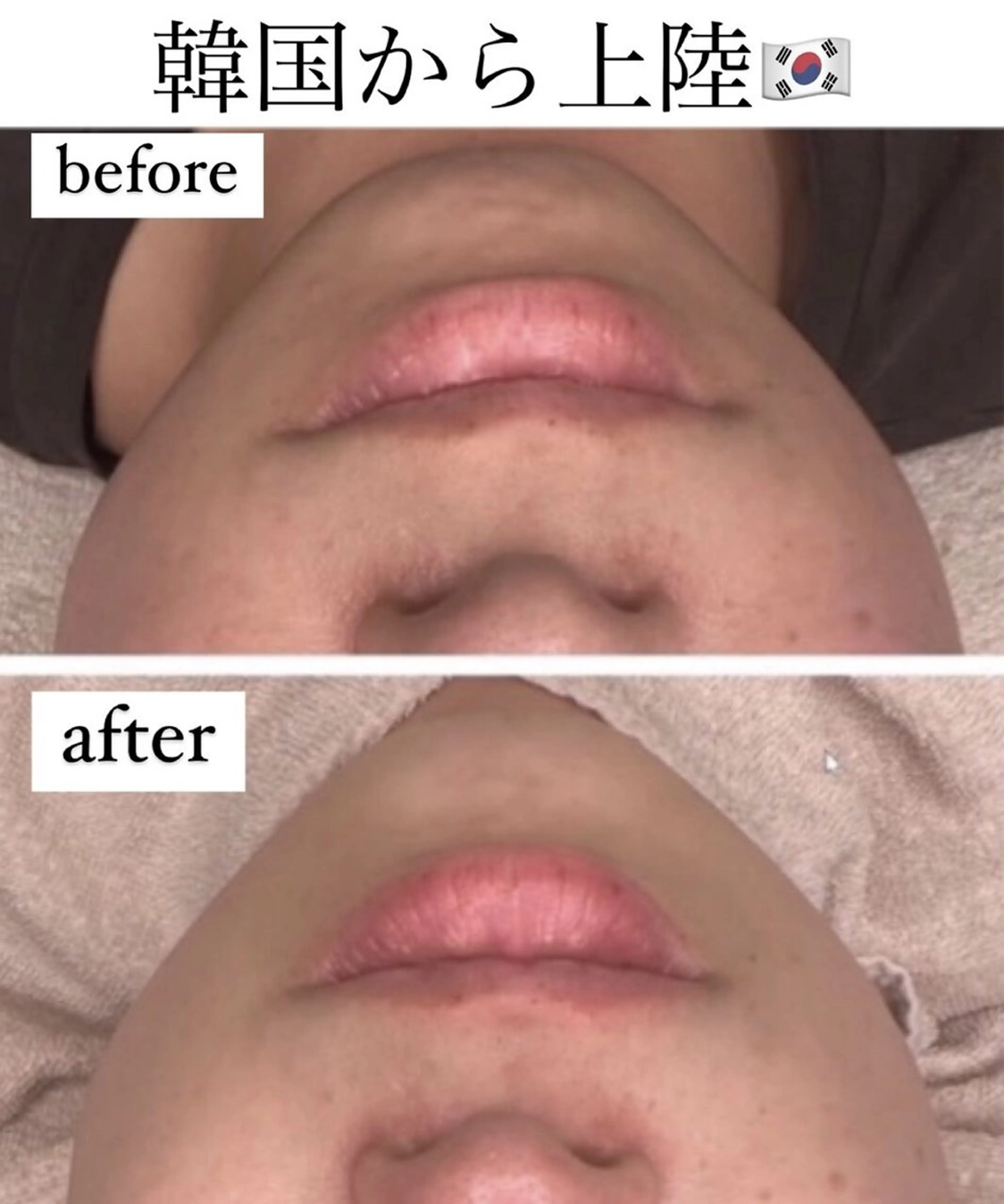 【毛穴洗浄+無針水光注入】《効果抜群》脂肪なくす！レモンボトル🍋たるみ/小顔に効果抜群☆の写真