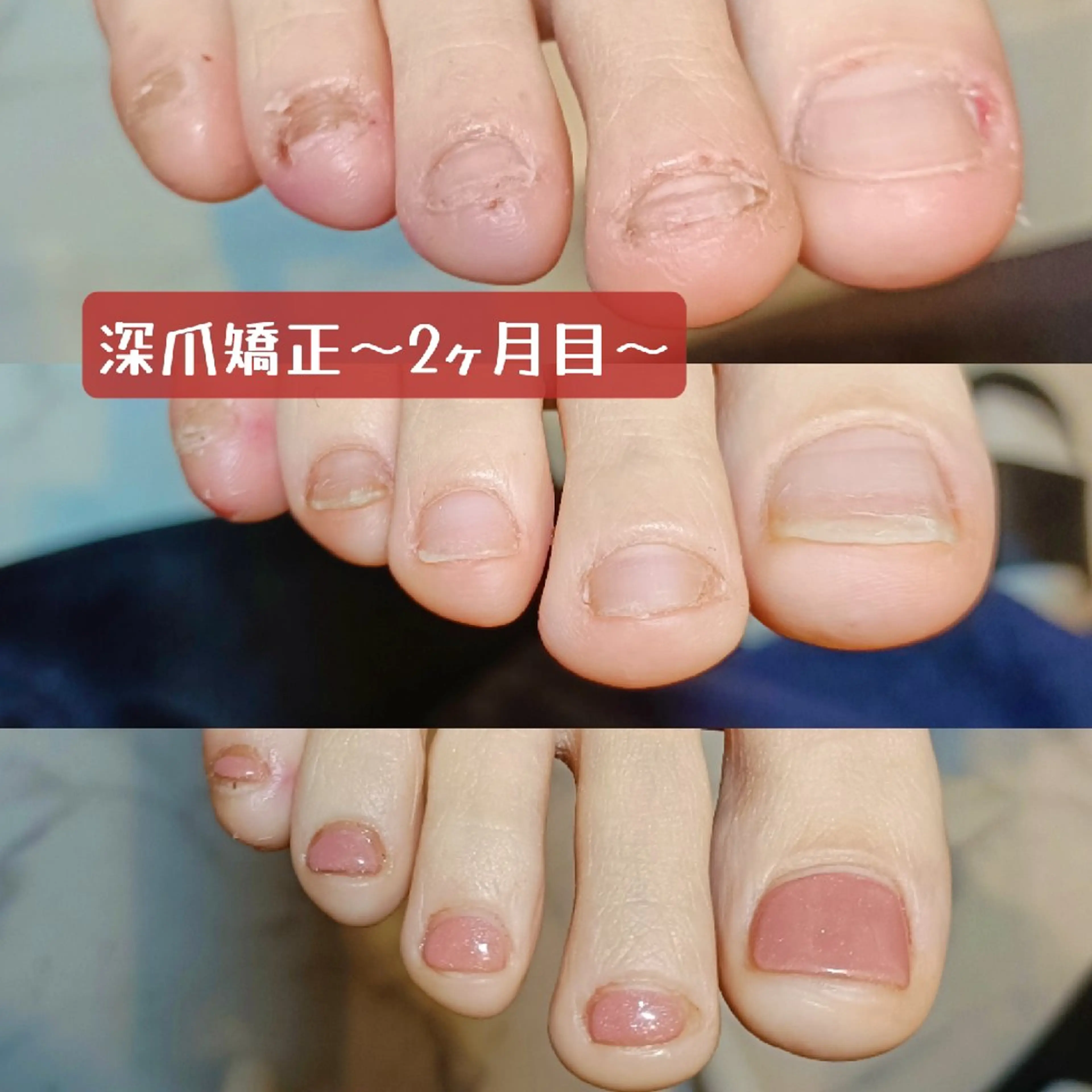 ネイル スカルプネイル フットネイル 深爪矯正/爪育成ケア manie nailのネイルデザイン