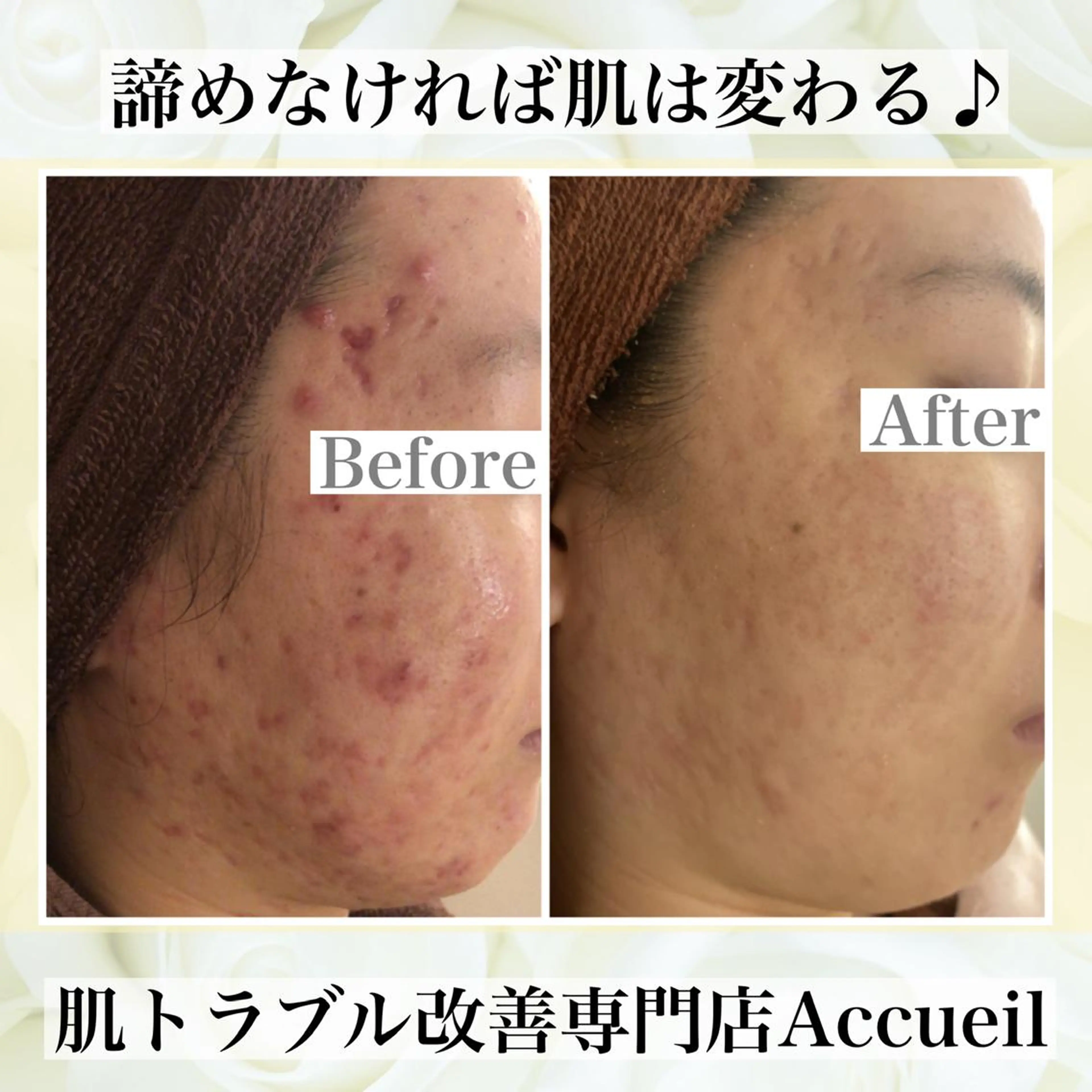 ミディアム カラー パーマ ヘアアレンジ メンズ キッズ ネイル マツエク・マツパ エステ リラク ニキビ・肌質改善専門 ♡人生が変わるサロンのエステ・リラクイメージ