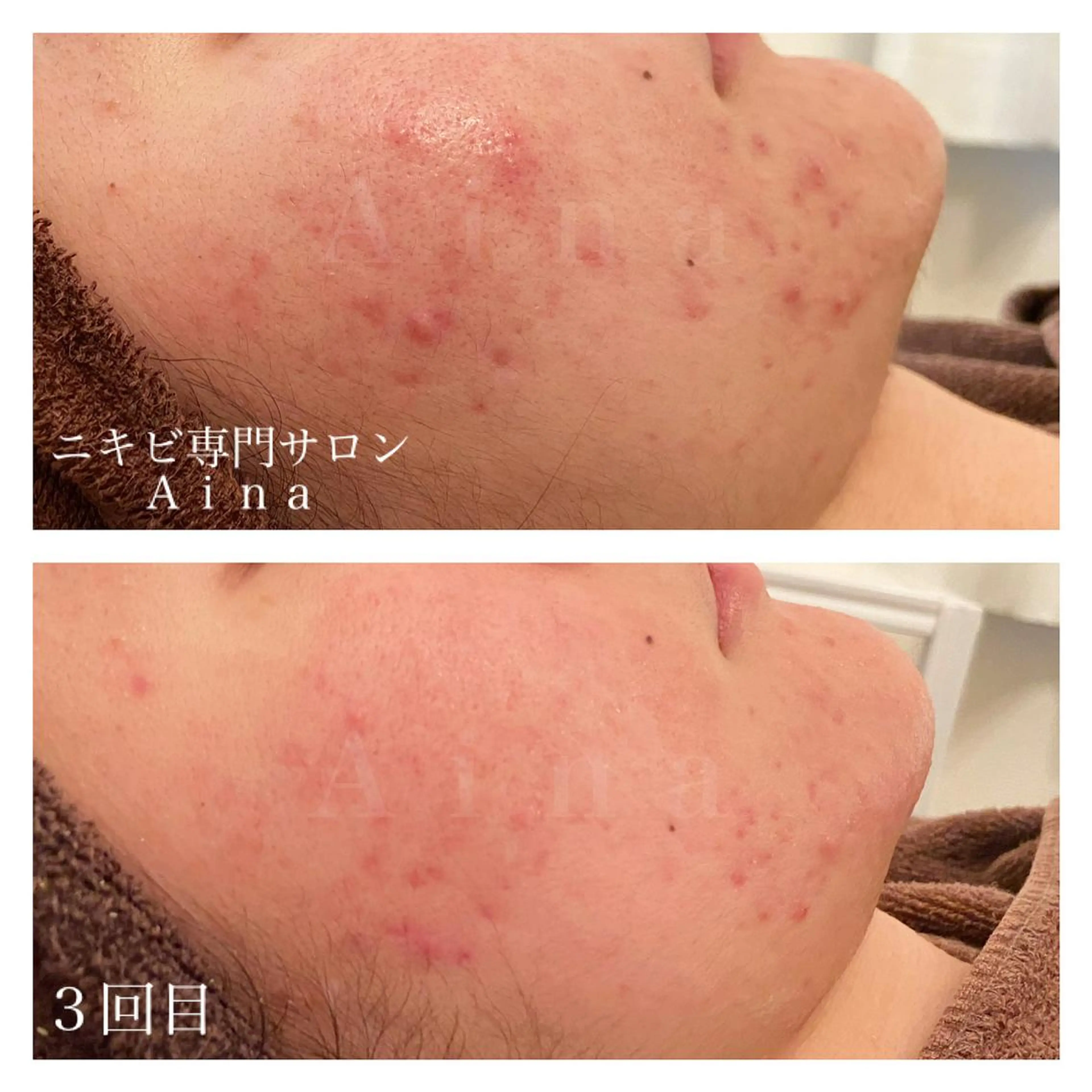 ミディアム カラー パーマ ヘアアレンジ メンズ キッズ ネイル マツエク・マツパ 赤色 エステ リラク ニキビ跡専門サロン Ainaのエステ・リラクイメージ
