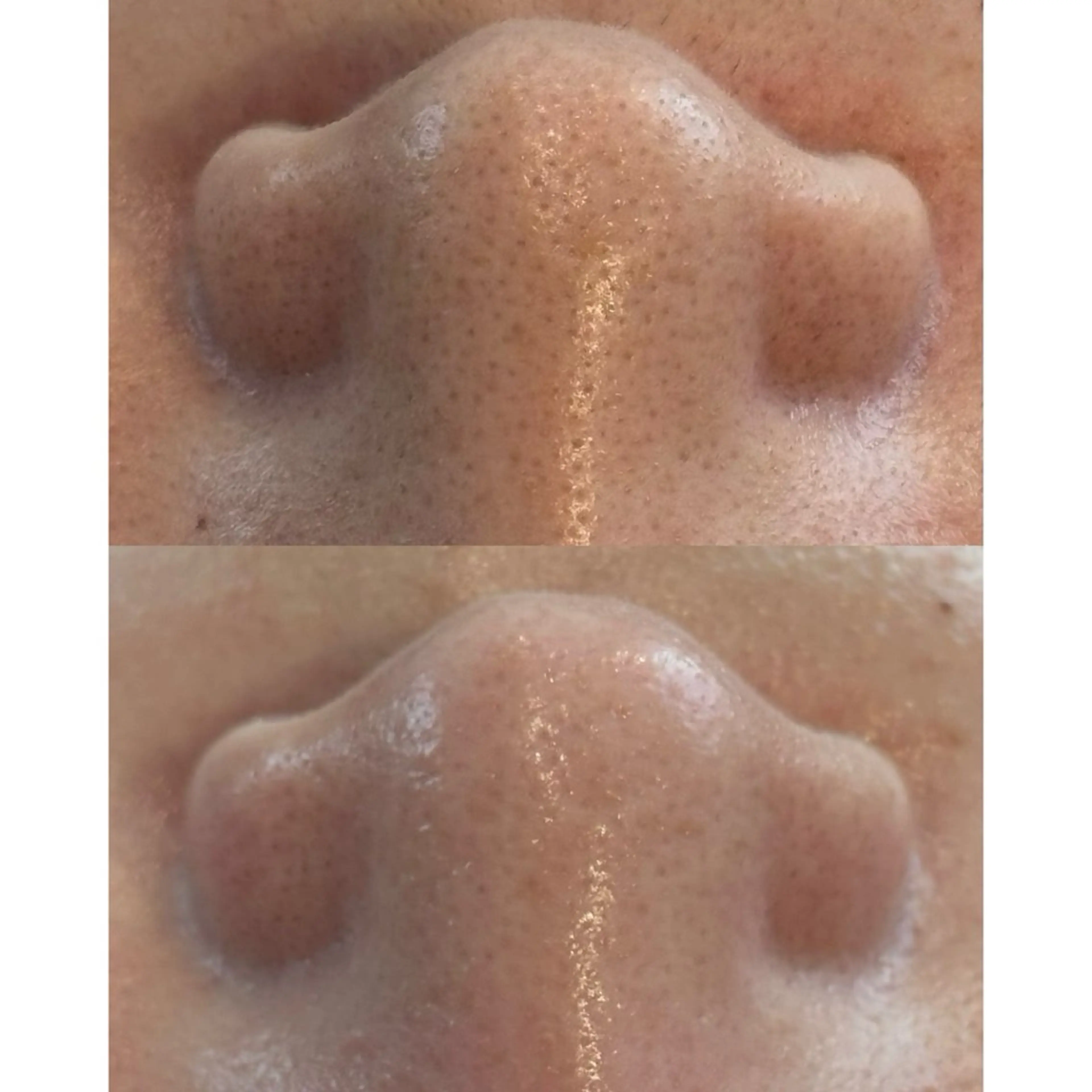 エステ リラク 艶肌ハーブピーリング /毛穴洗浄のエステ・リラクイメージ