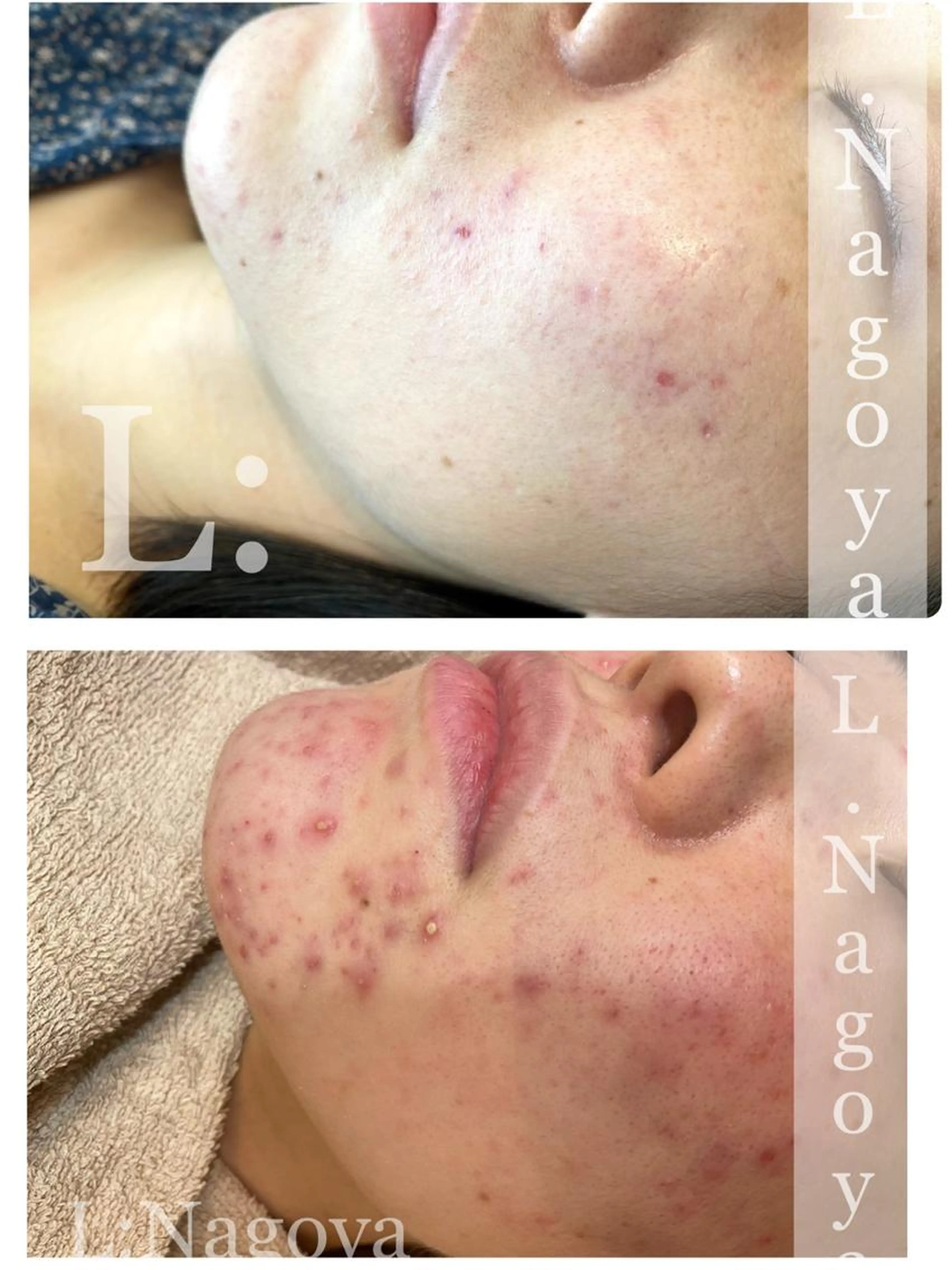 新作◇剥けるピーリングってどんな感じ?『初めての剥けるハーブピーリング』の写真