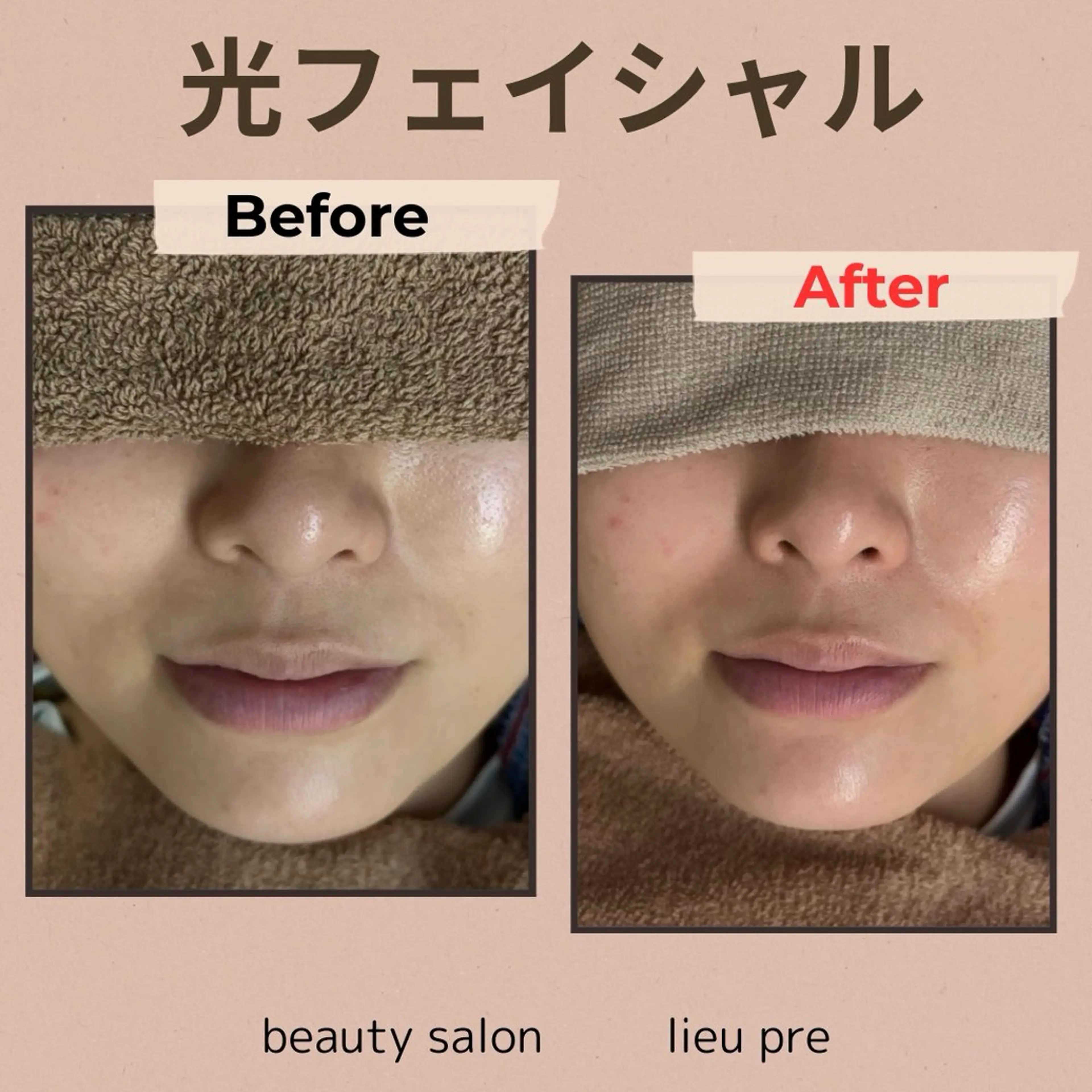 脱毛 lieupré 脱毛 oshima‎⌣̈のエステ・リラクイメージ