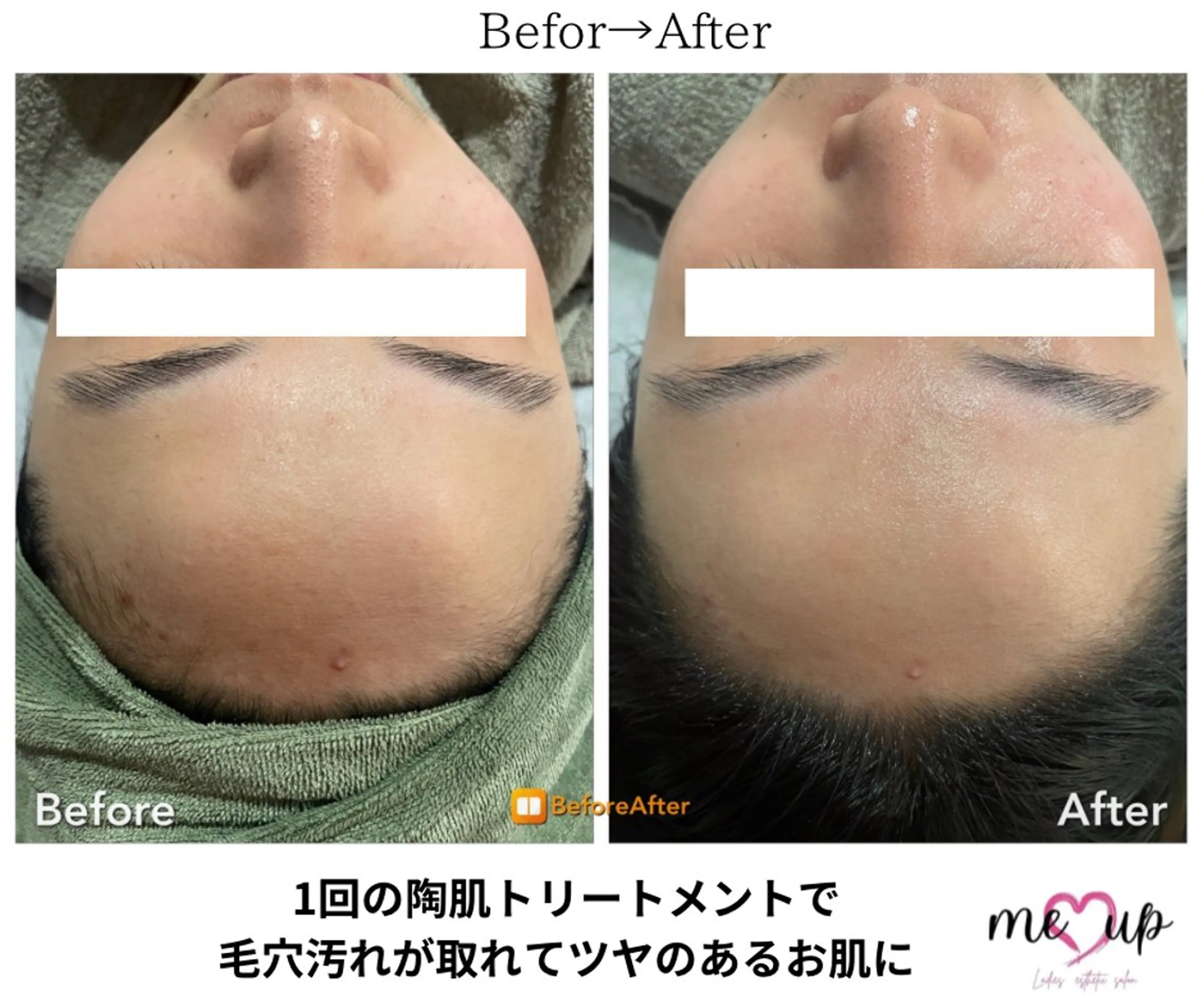 エステ Meupニキビ専門店 背中/ハーブ/肌管理のその他イメージ