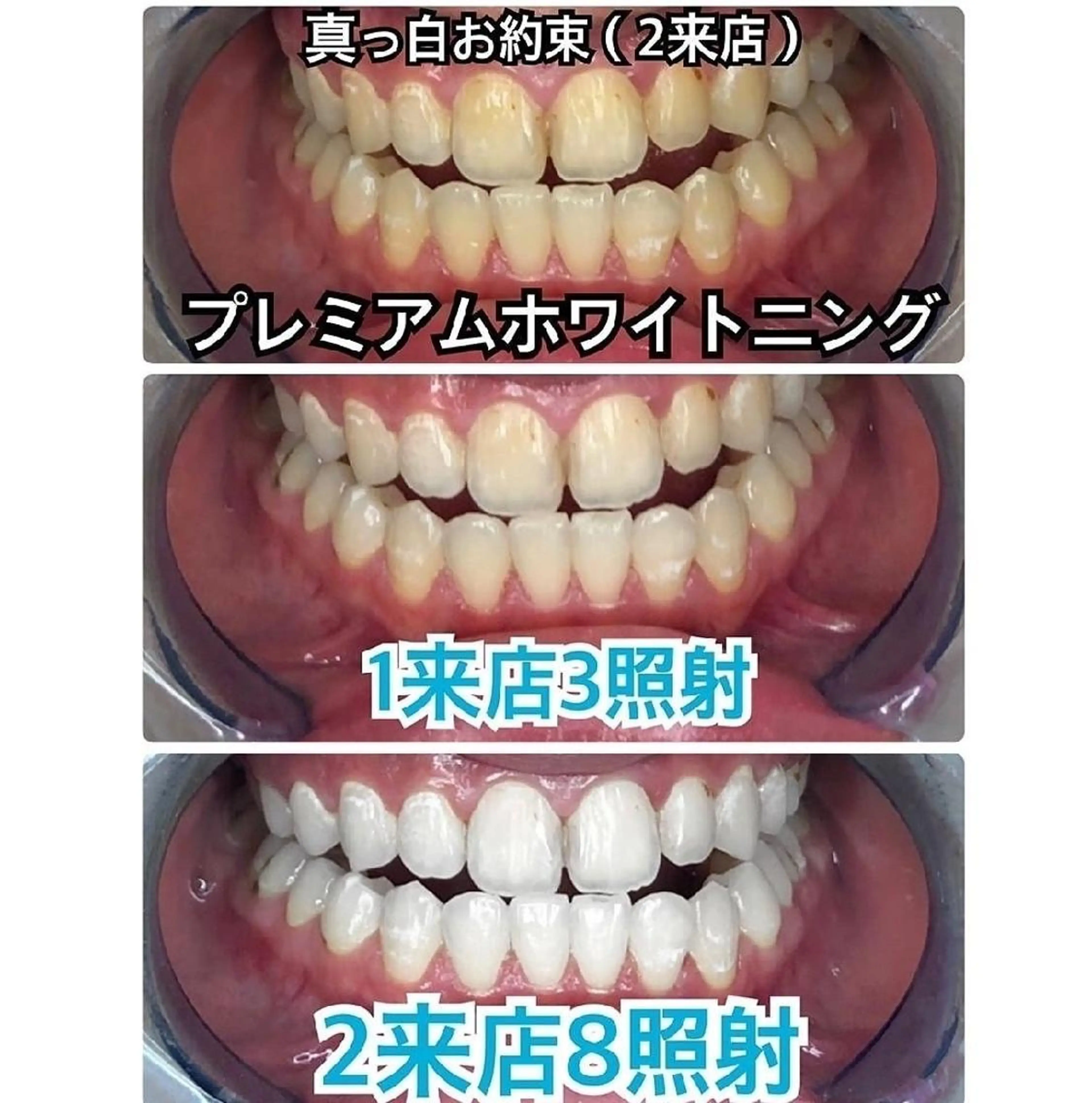 【人気No.1】プレミアムコース❣合計 8回 2 来店（1回10分照射）❣ジェル代別途の写真