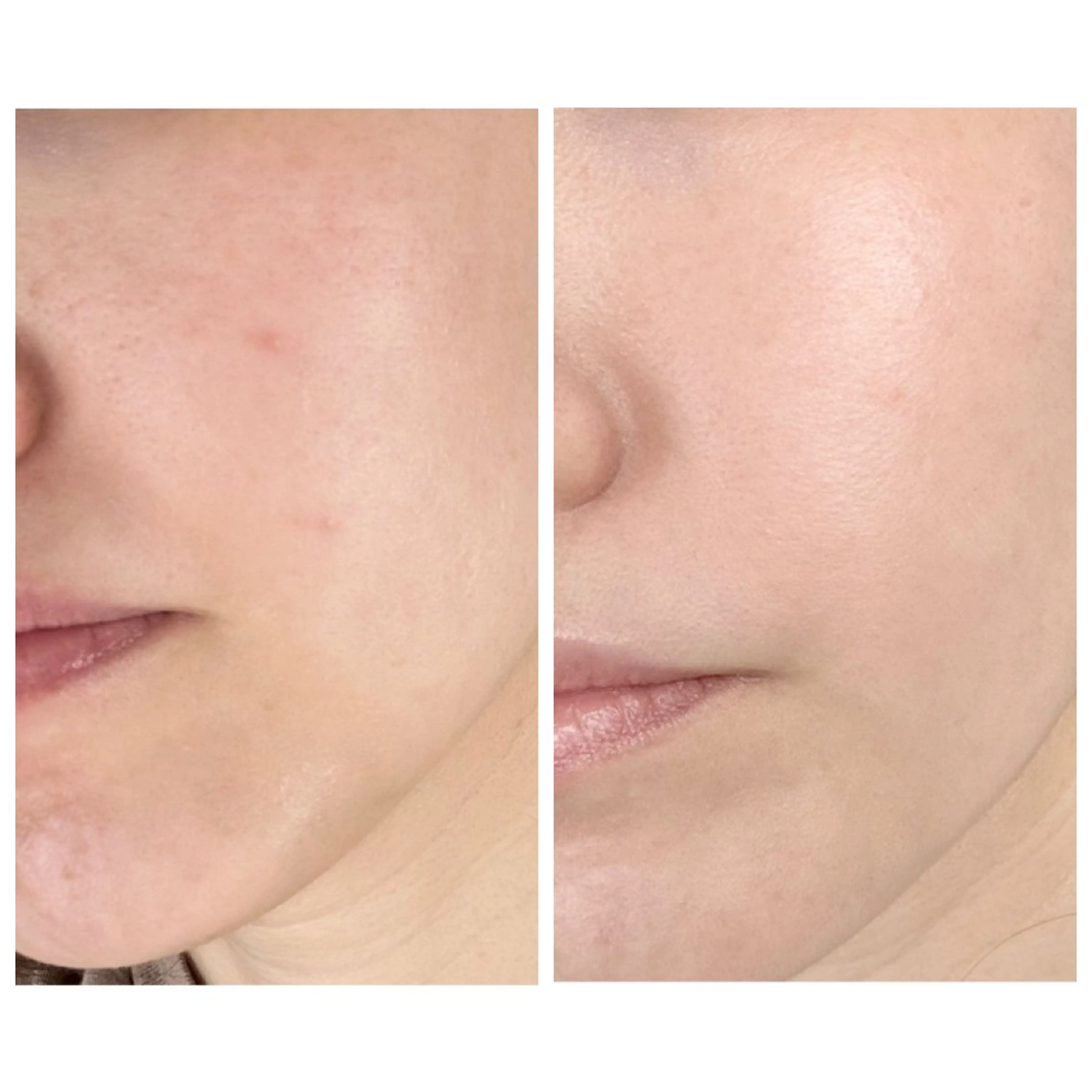 エステ ニキビ/敏感肌/乾燥 Lilyauraのエステ・リラクイメージ