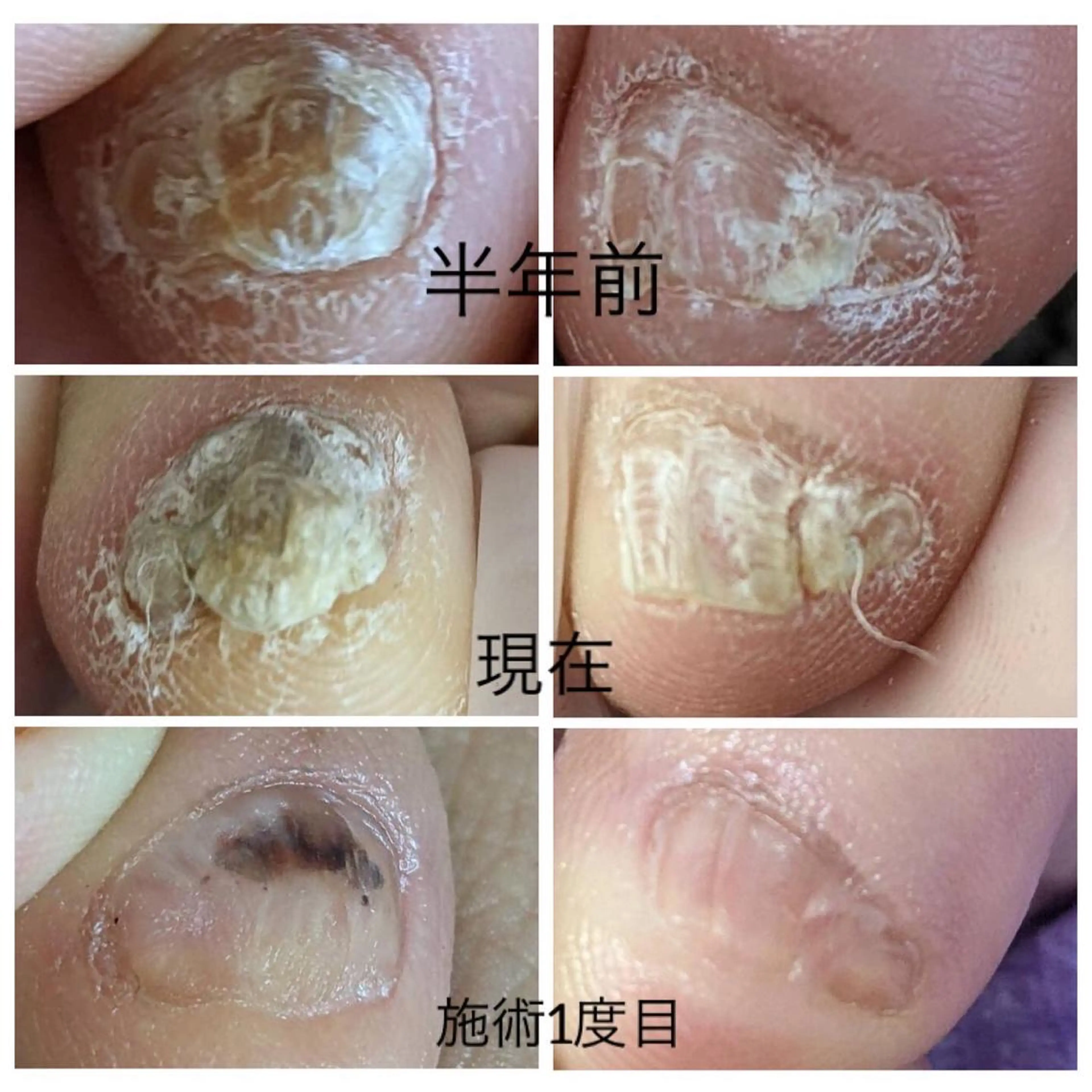 フット巻いたお爪などのケア5500円の写真