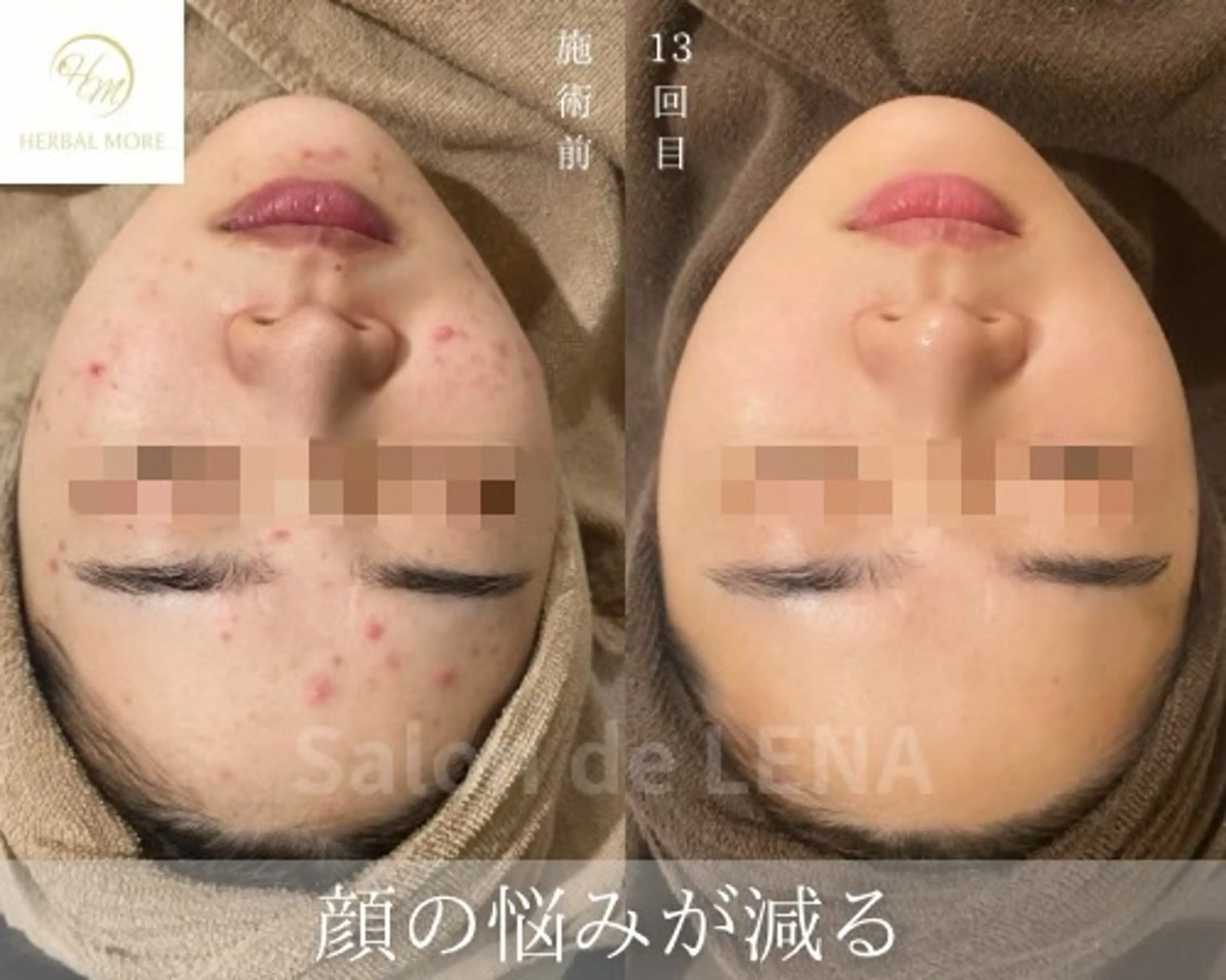 【Xmasイベント】剥けない艶肌ハーブピーリング《顔用》の写真