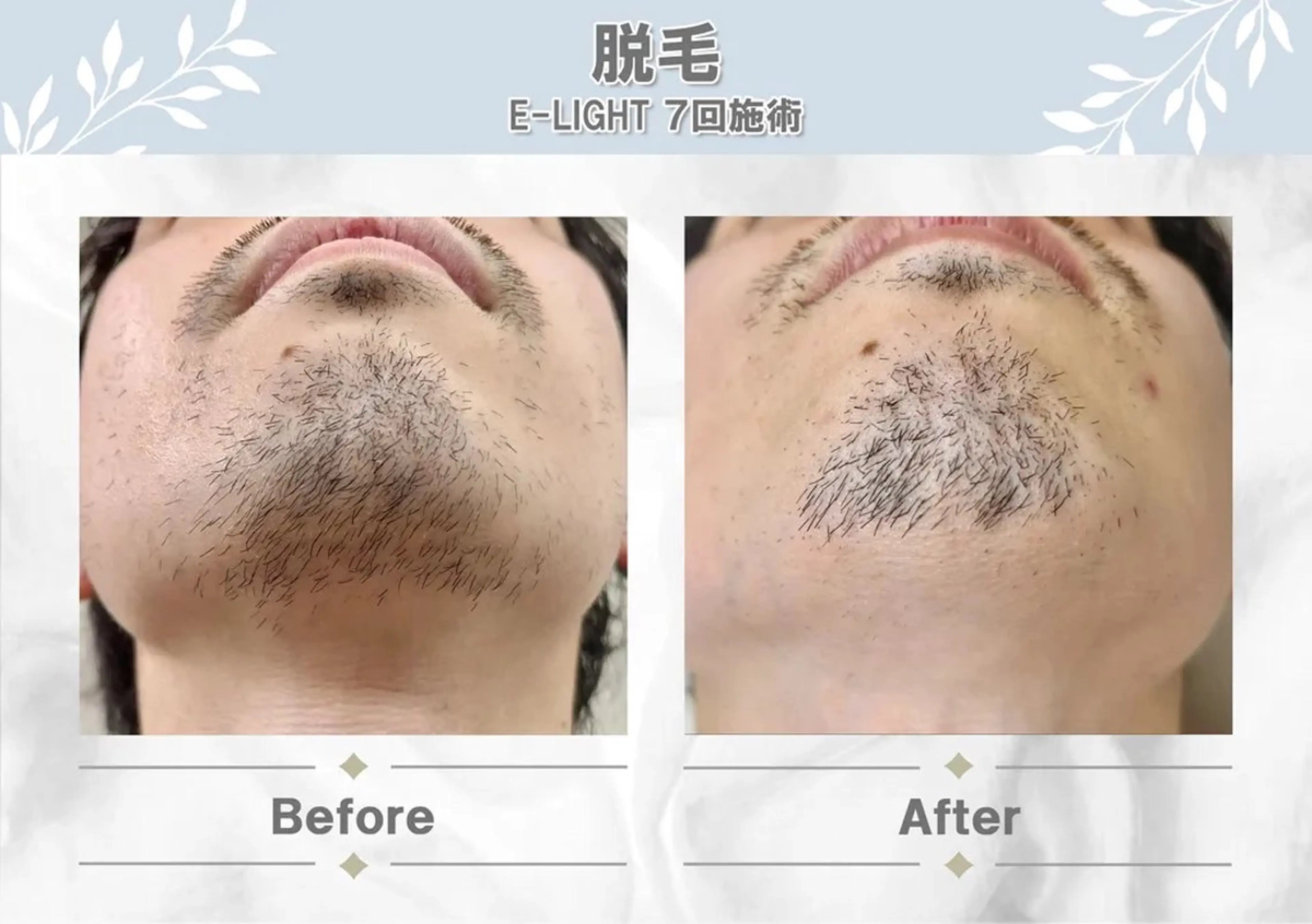 🥸メンズ脱毛ひげ全体🥸の写真