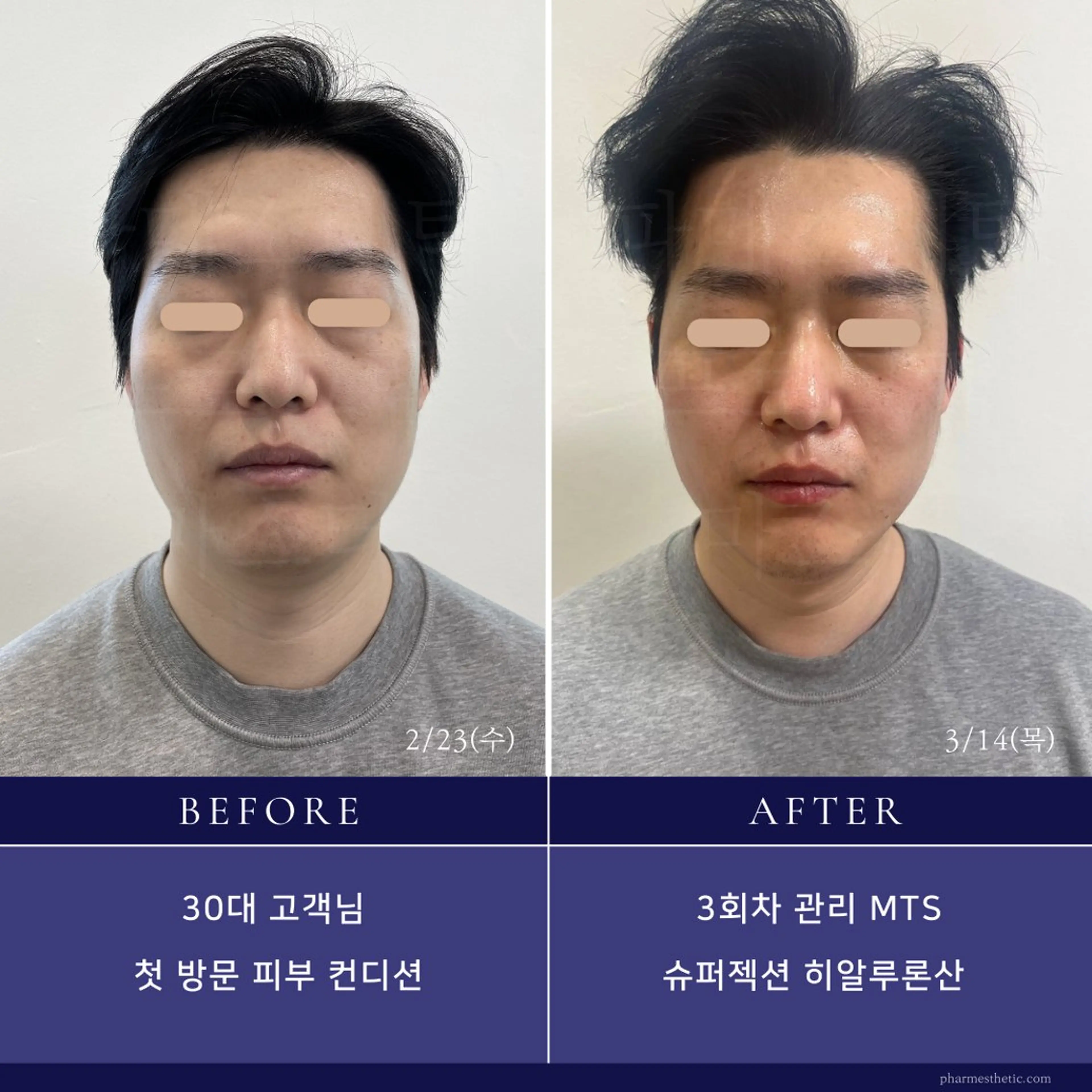 スーパージェクション韓国式肌管理の写真