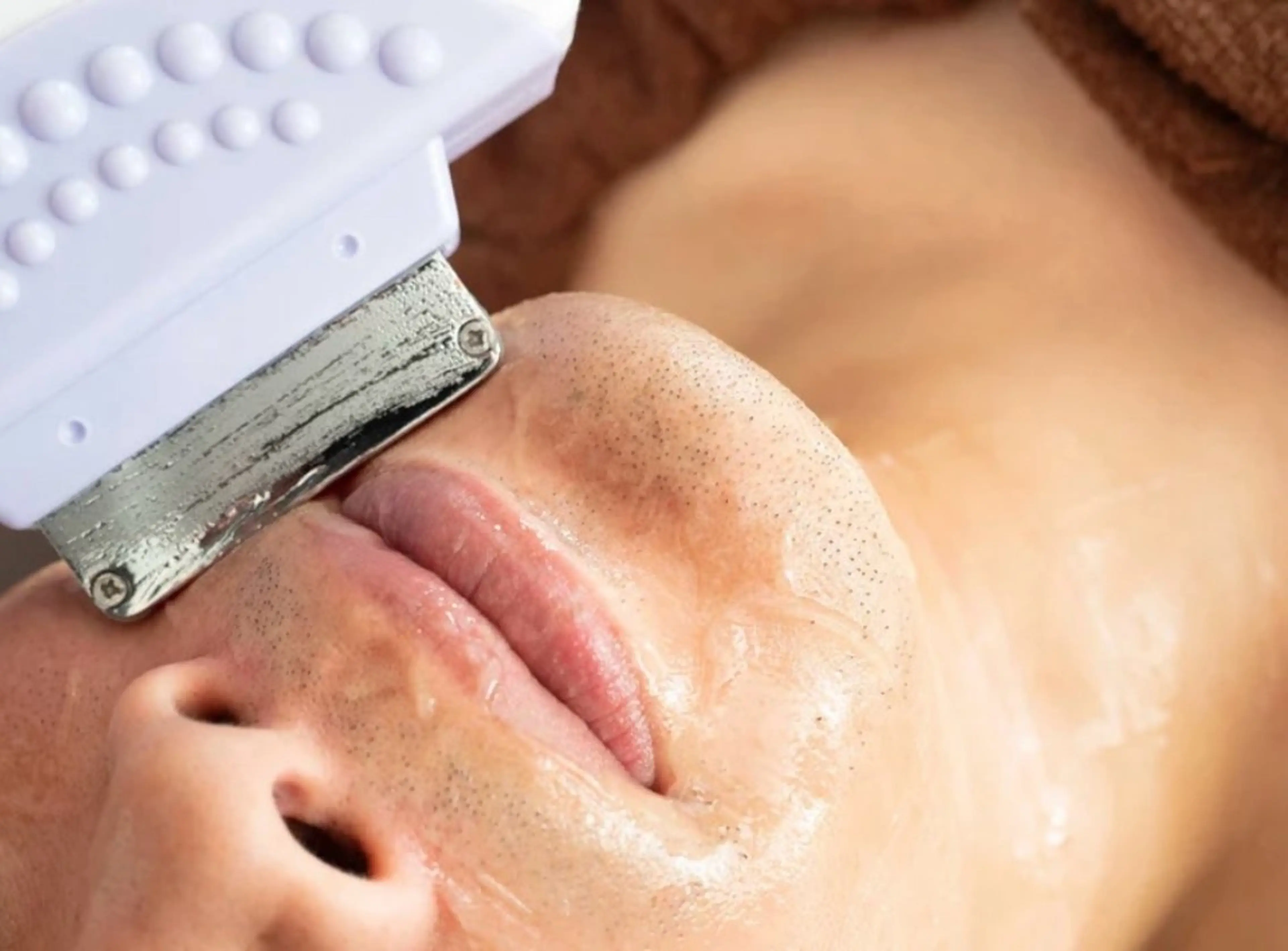 ヒゲ脱毛の写真