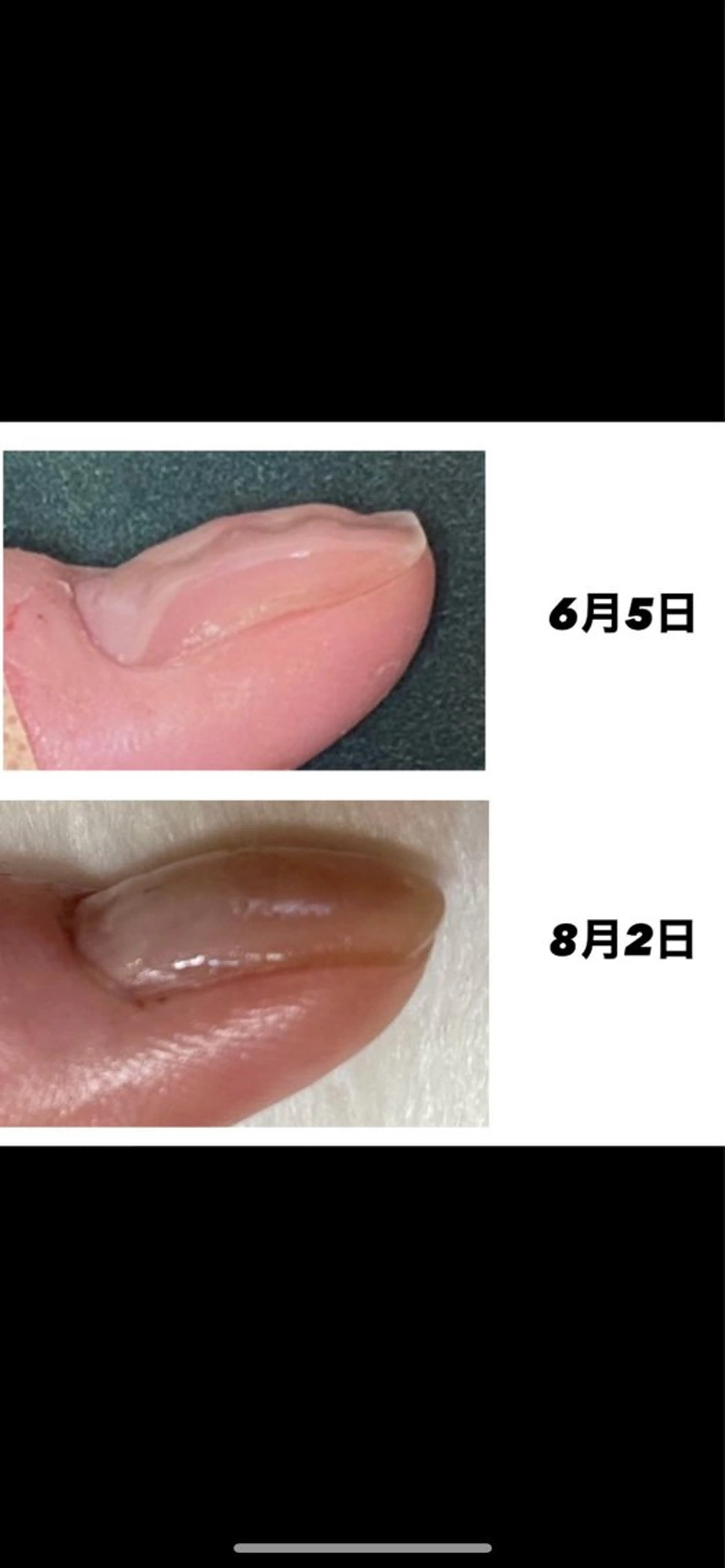 自爪育成　（深爪など）　ケア、強化剤使用　クリア仕上げの写真