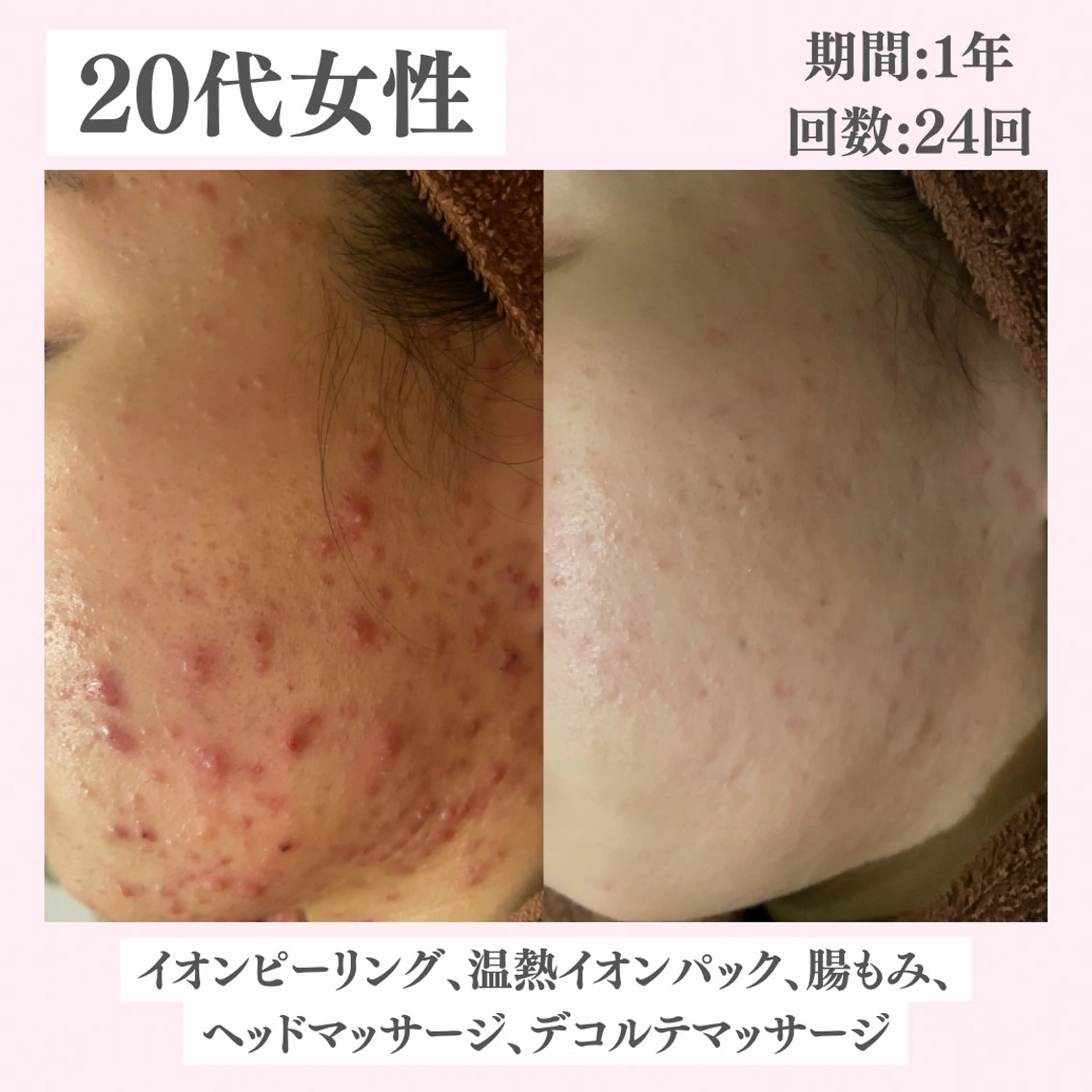 エステ リラク ニキビ・肌質改善専門 ♡人生が変わるサロンのエステ・リラクイメージ