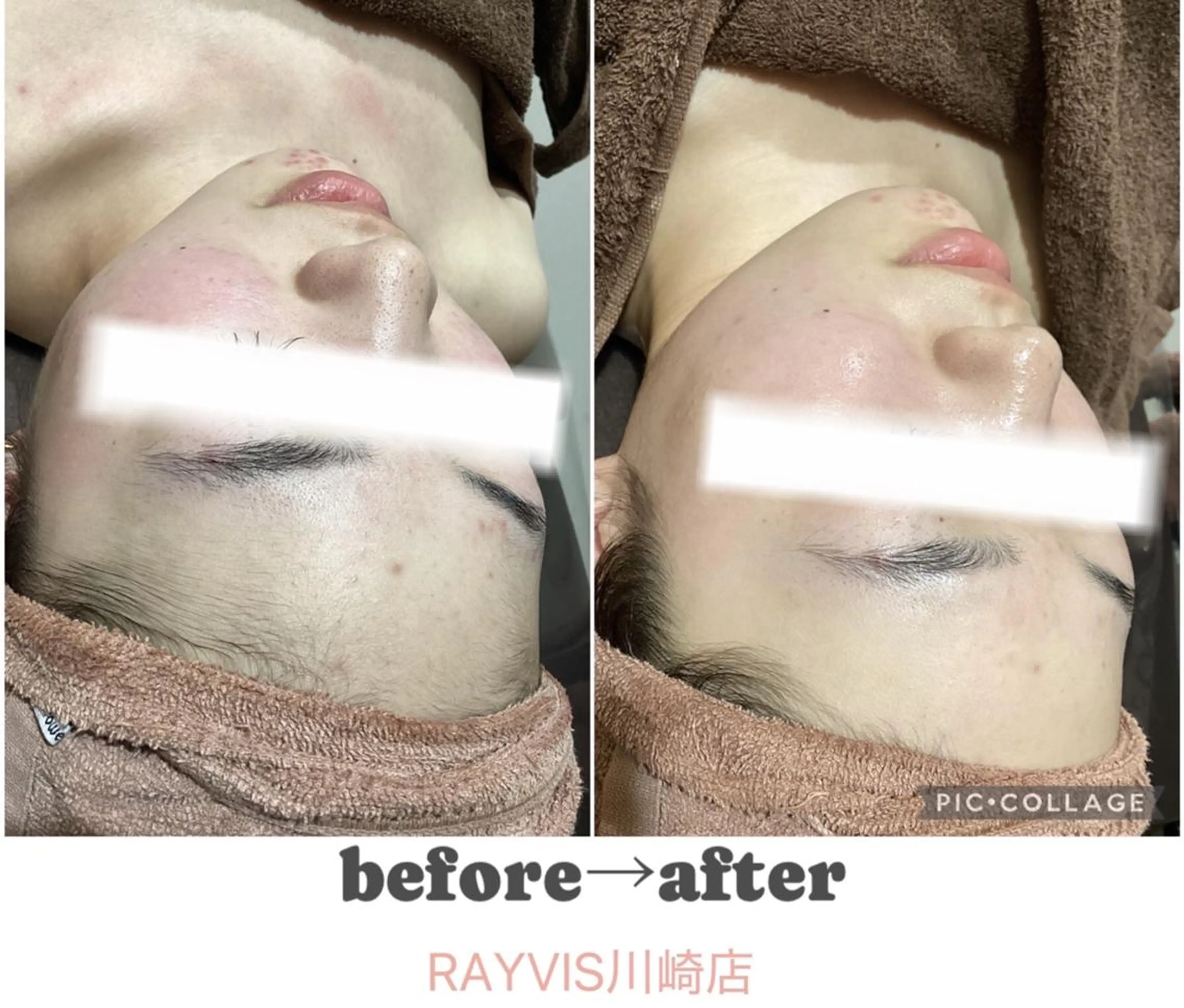 脱毛 🌷毛穴エステ レイビスMURA🌷のエステ・リラクイメージ