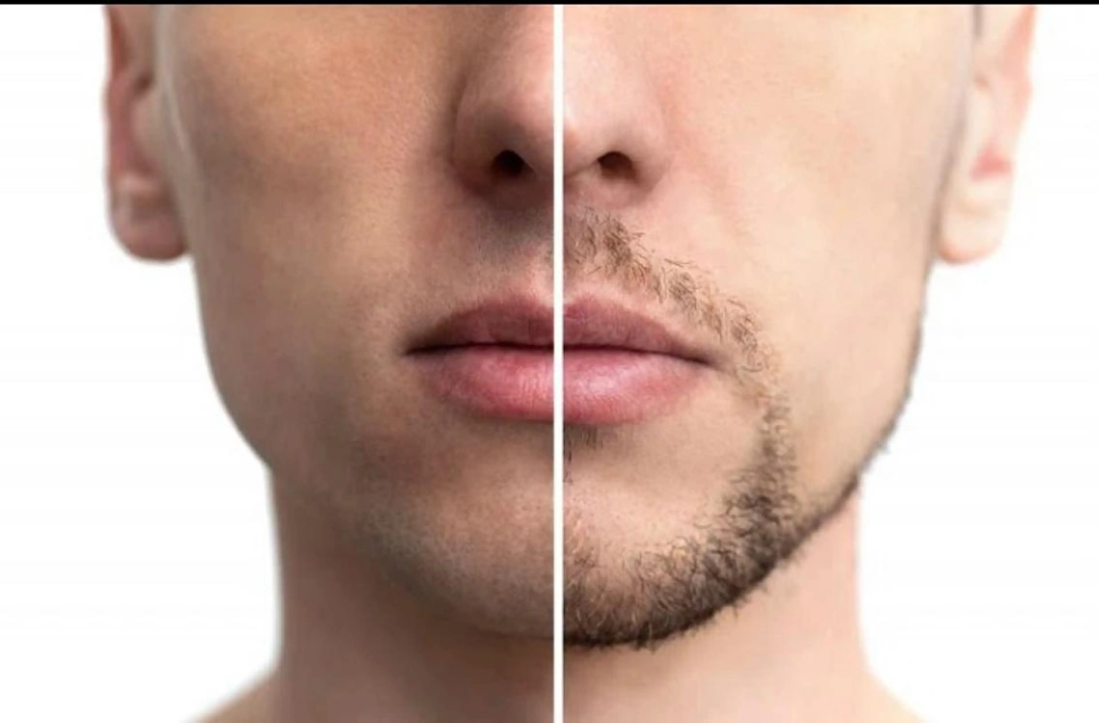 メンズひげ脱毛(口周り)の写真