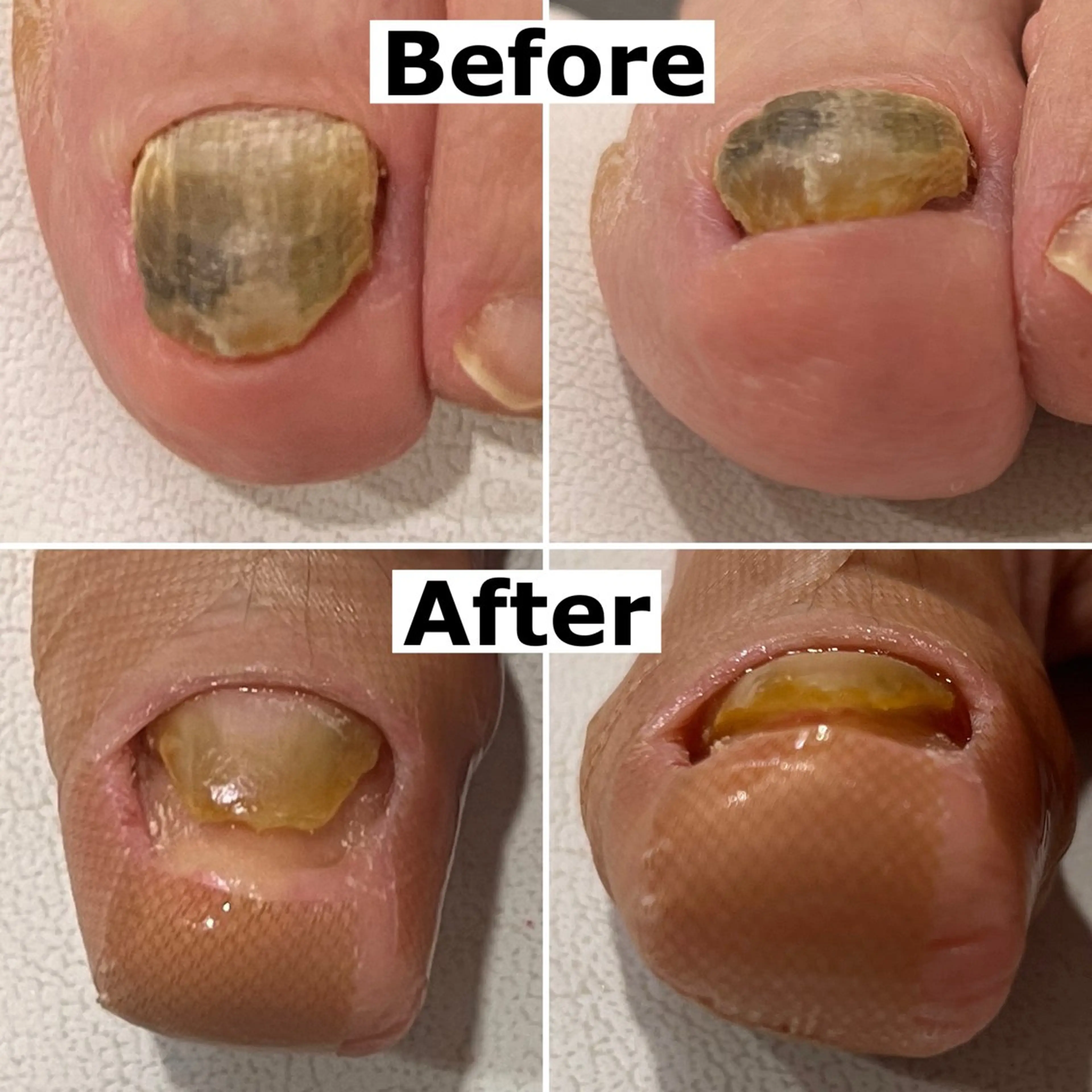 ネイル Mellow nail所属・巻爪無料モデル募集 ✨🦶MEGUMIのネイルデザイン