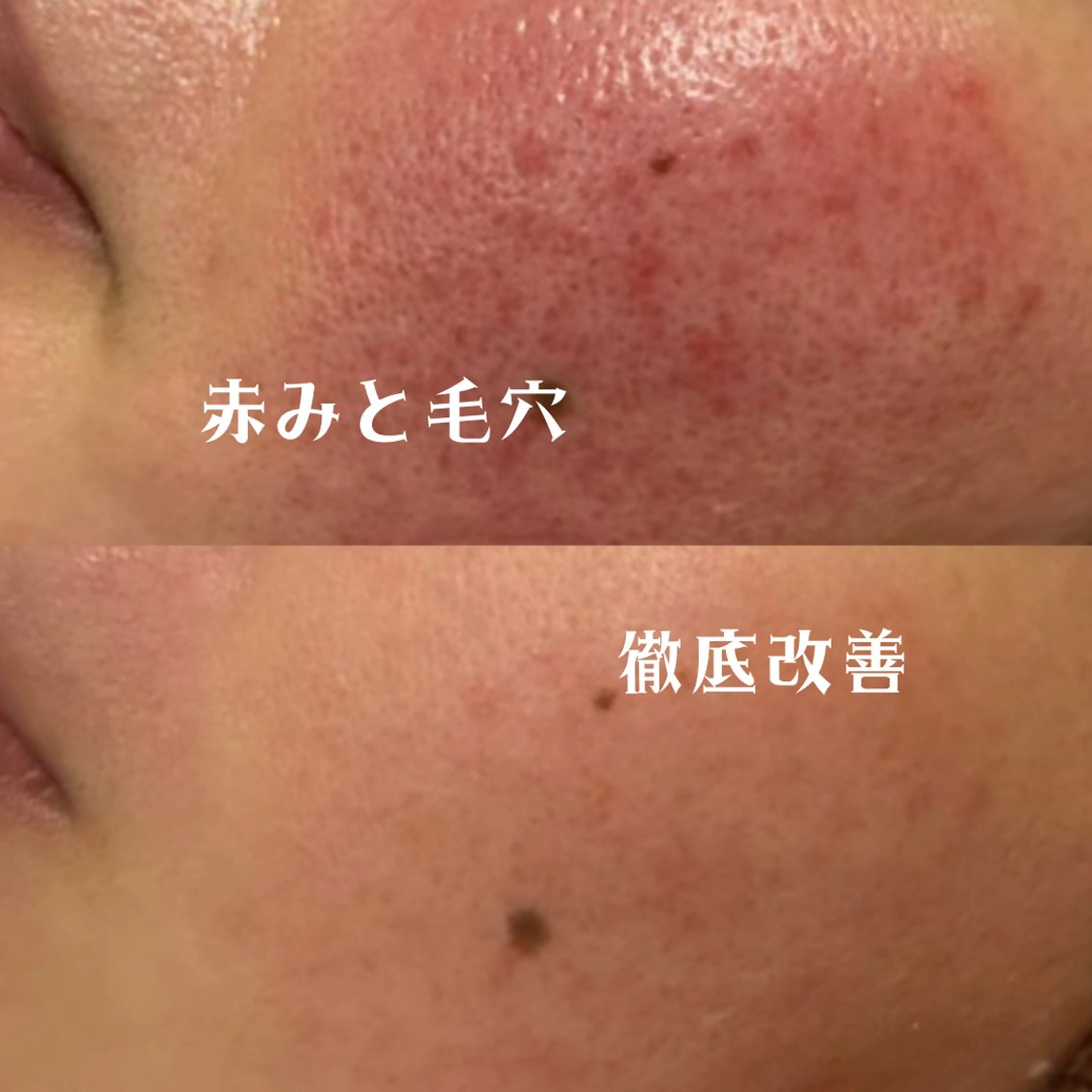 【肌質を変えたい方は絶対にこれ❕✨】根深いニキビ・ニキビ跡+Wケア🎁当店のフルコースを限定価格でご案内🉐🤎の写真