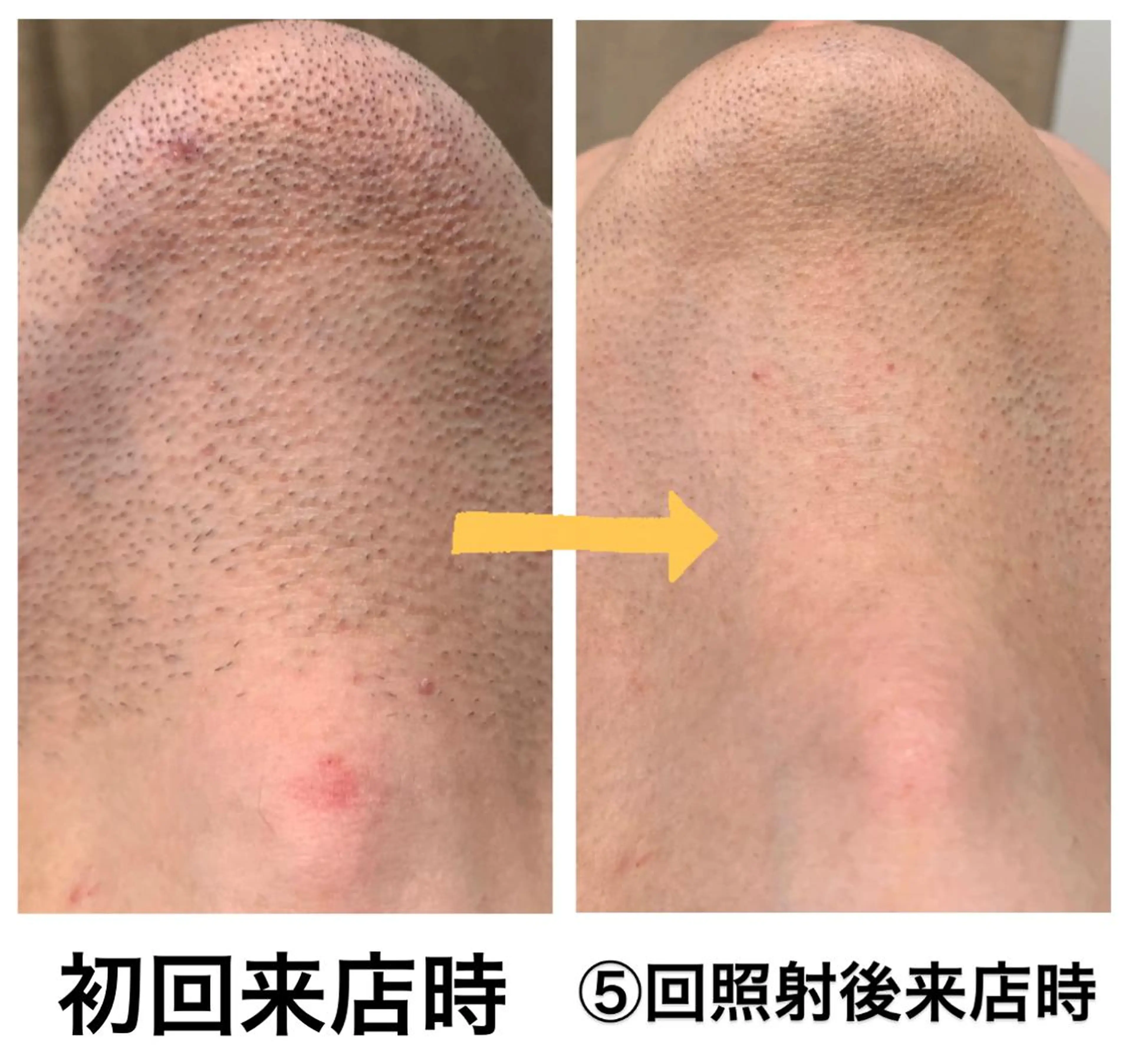 脱毛 メンズ脱毛サロン Le falcoのエステ・リラクイメージ