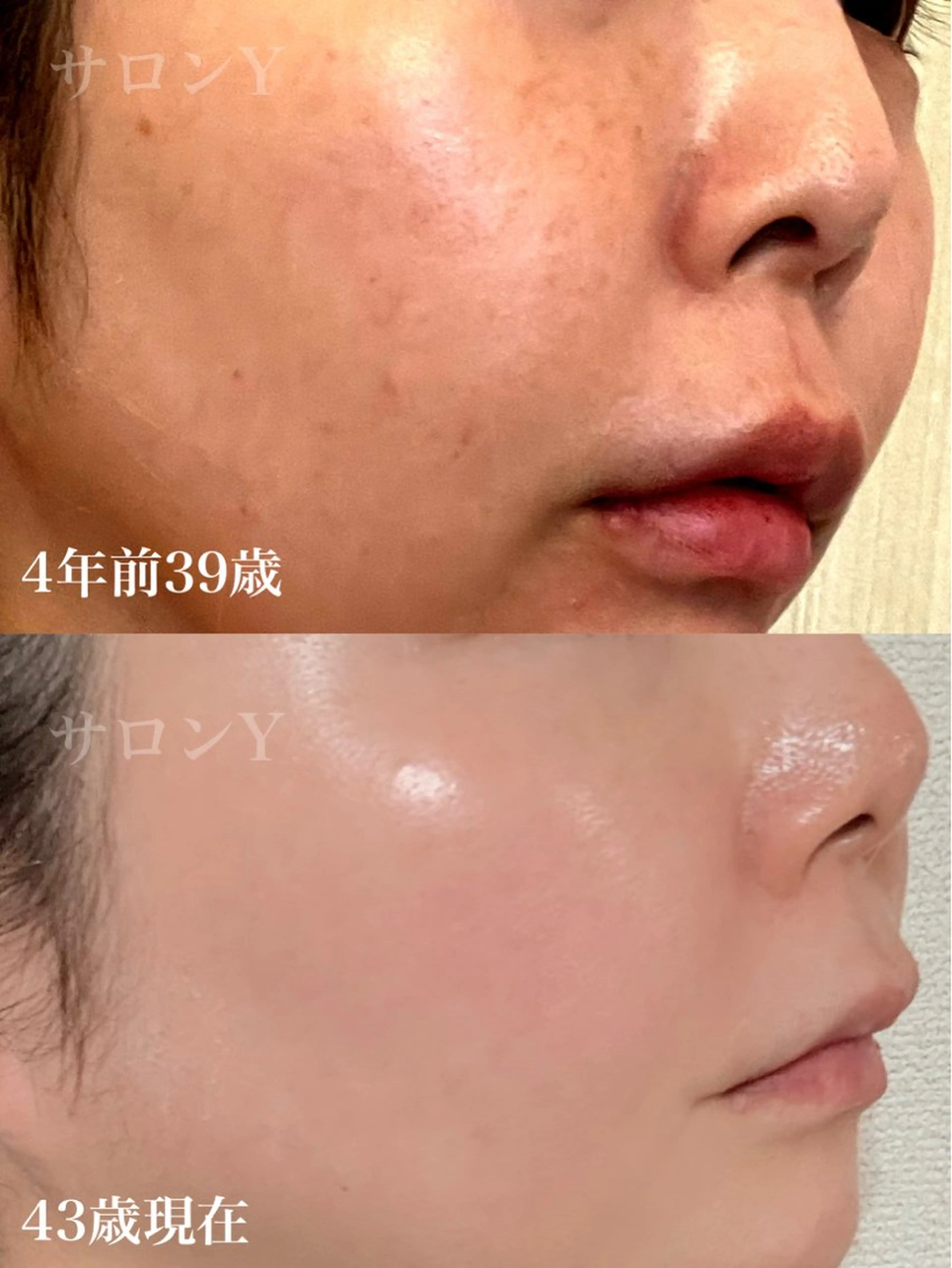 業界最高峰★グリーンピール5days★(5日後のアフタートリートメント込み)下記の専用メニューと一緒にご予約下さい。の写真