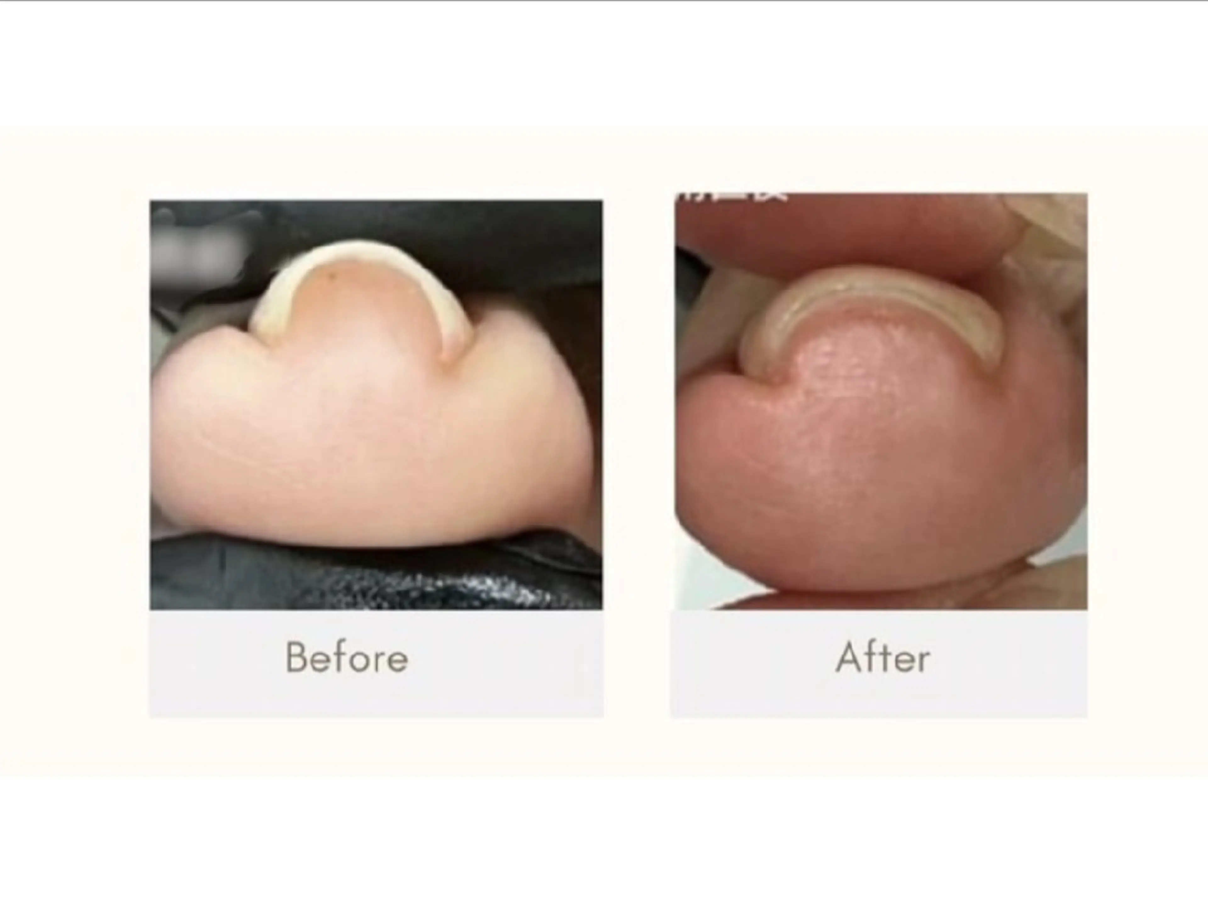 巻き爪改善ネイル👣の写真