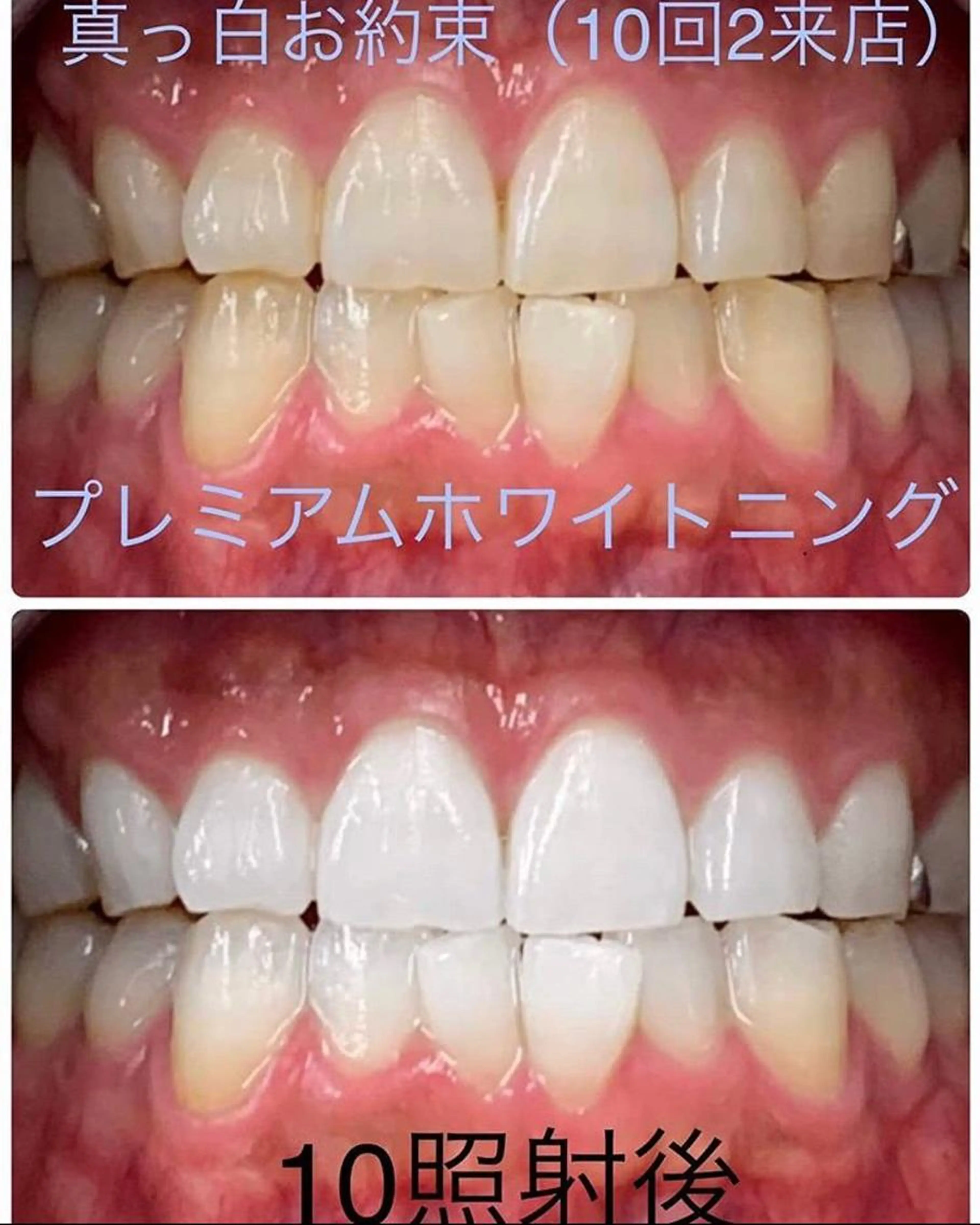 ☆Wプレミアムホワイトニング☆《3来店メニュー》の写真