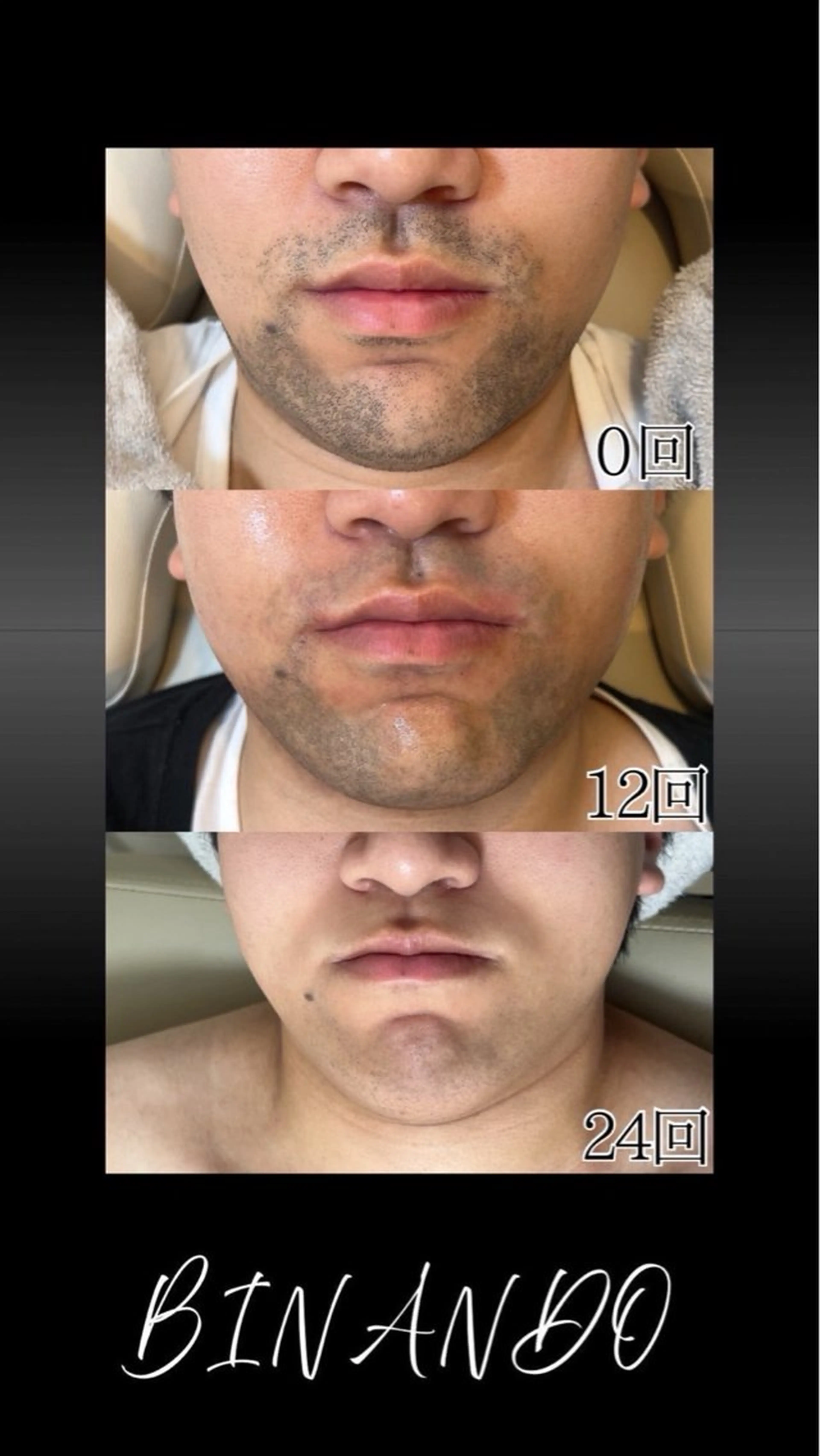 脱毛 BINANDO 鎌田のエステ・リラクイメージ