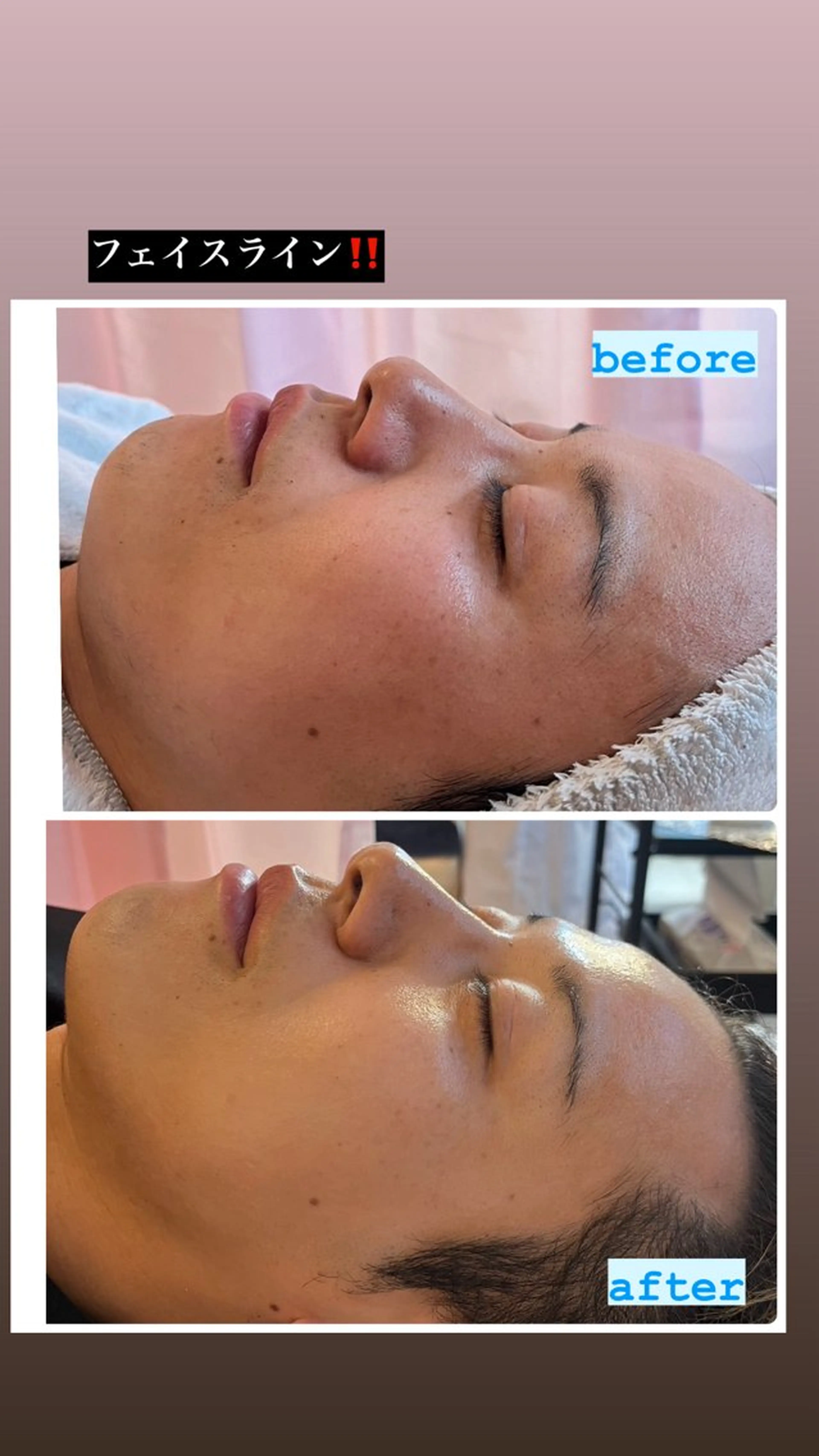 ハーブピーリング/韓国肌管理/フェイシャル/毛穴洗浄/眉毛/顔脱毛【糸脱毛専門】rev所属・ハーブピーリング専門 毛穴洗浄❤️眉waxのエステ・リラクイメージ