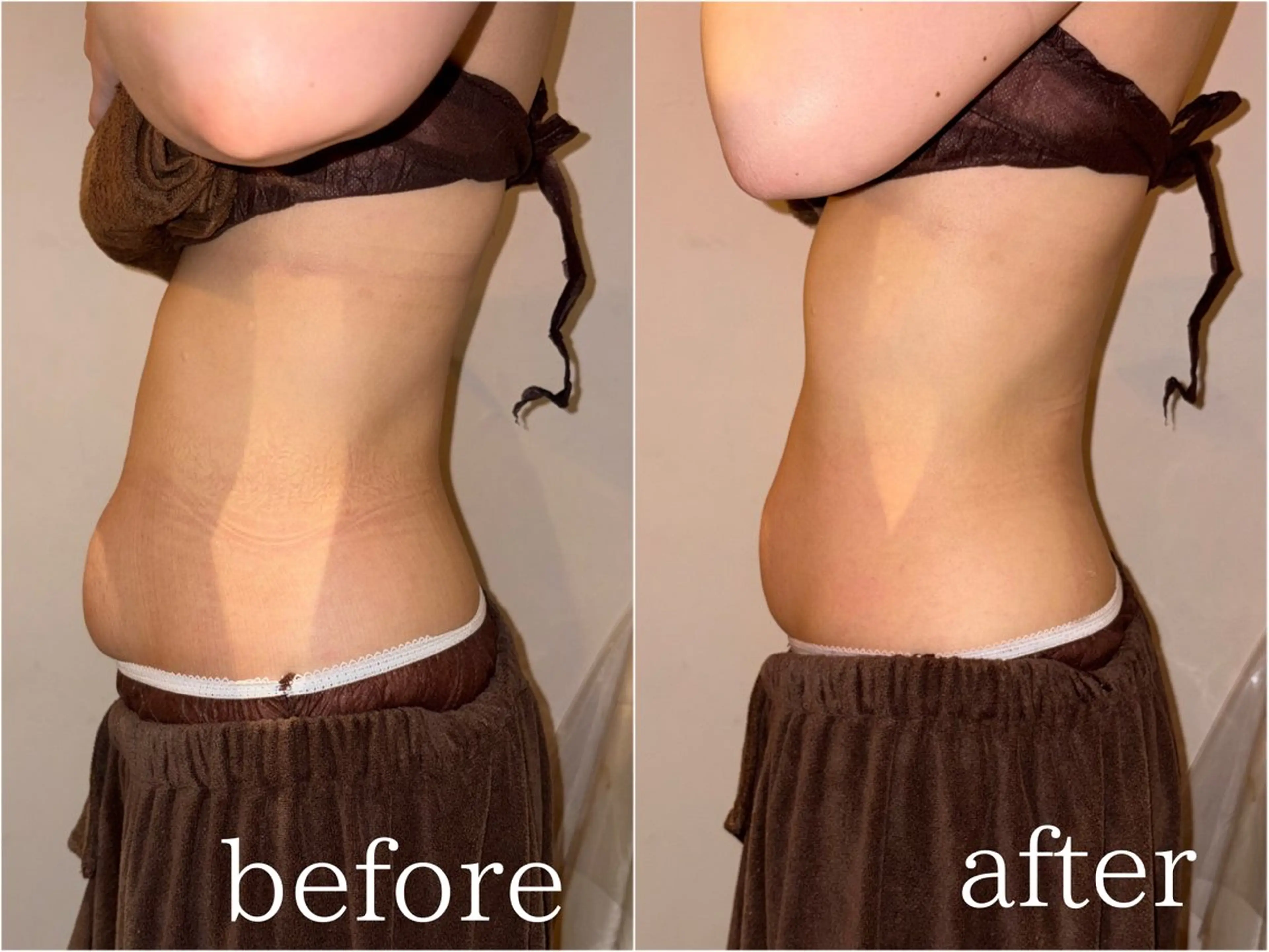 【ミニモ限定価格★上半身痩身】上半身（お腹or二の腕or背中）＊ラジオ波×キャビテーション×吸引×EMSの写真