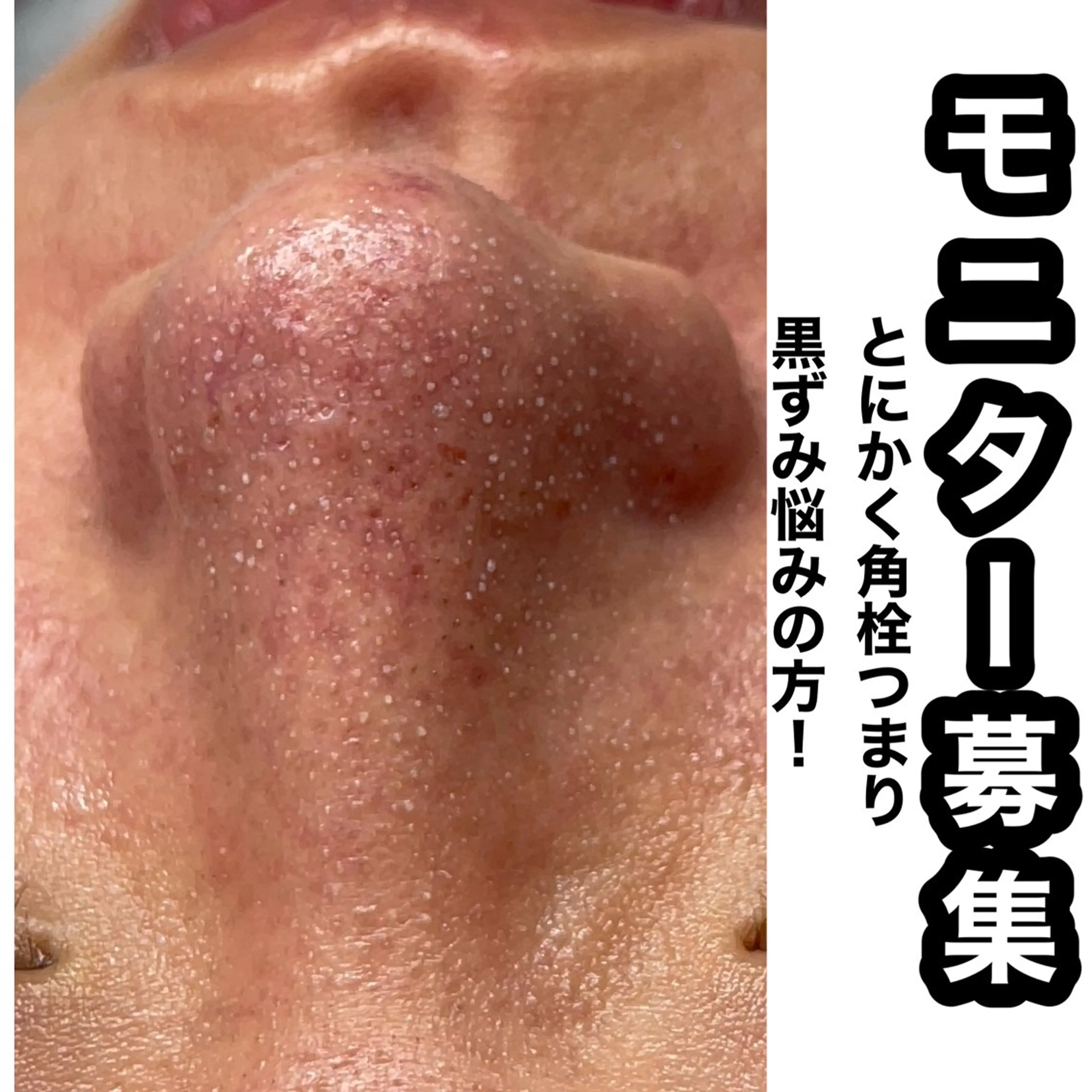 エステ Chalon所属・REVI取扱・肌悩み 毛穴Chalonのエステ・リラクイメージ