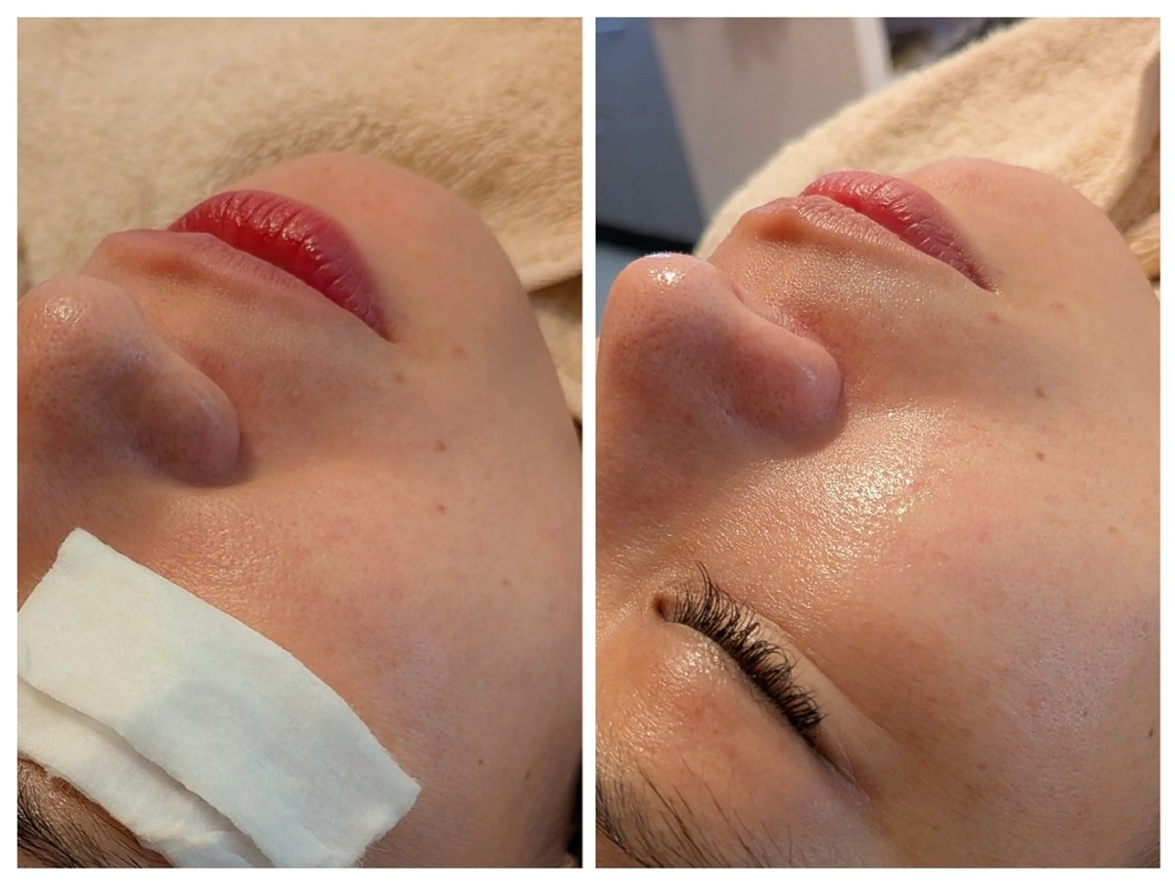 お肌を整えるハーブピーリング (剥離なし) 90分10000円の写真