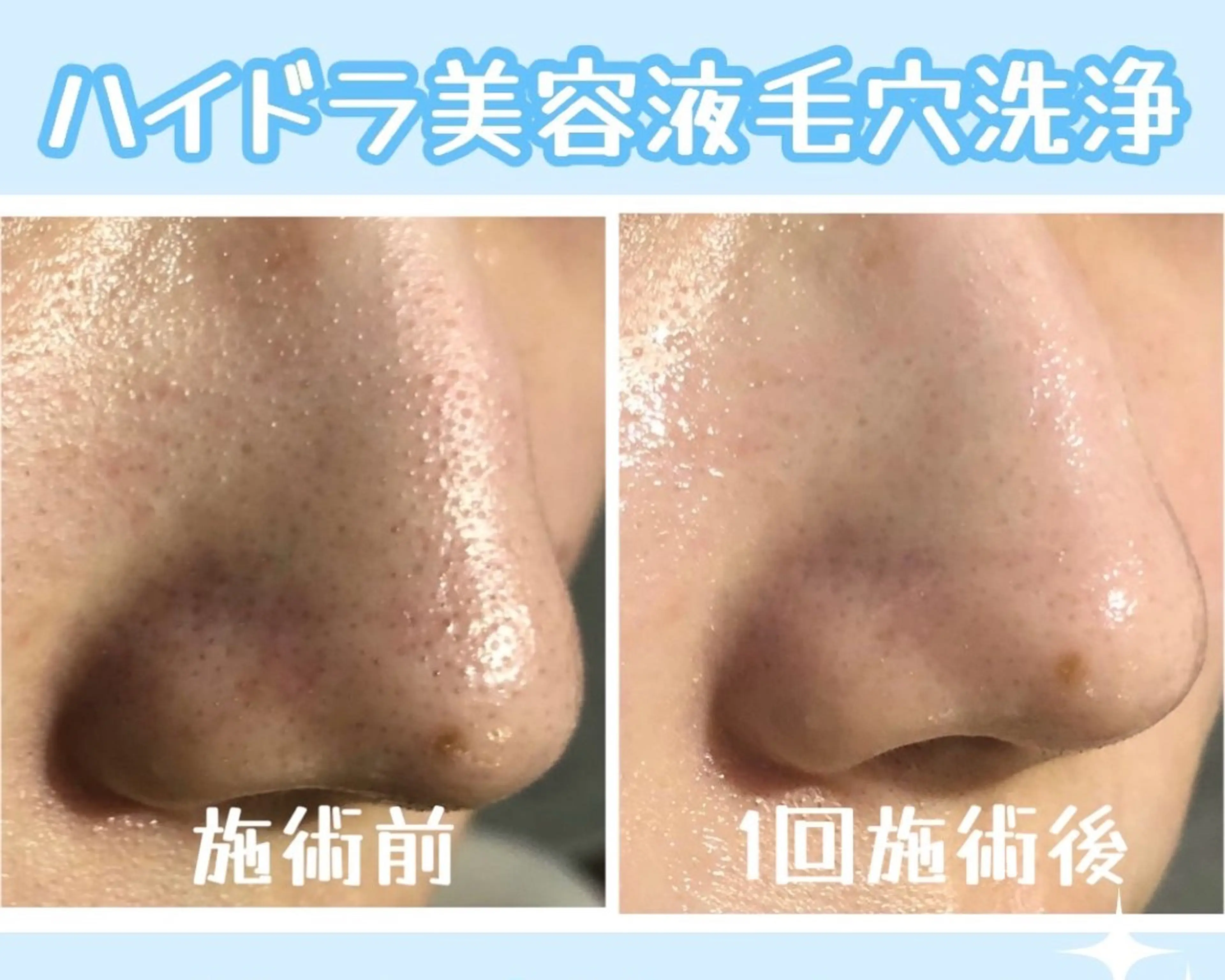 美容液で洗浄するハイドラ毛穴洗浄✨頭皮洗浄セット!いちご鼻や頭皮の匂いにお悩みの方お試しください!の写真