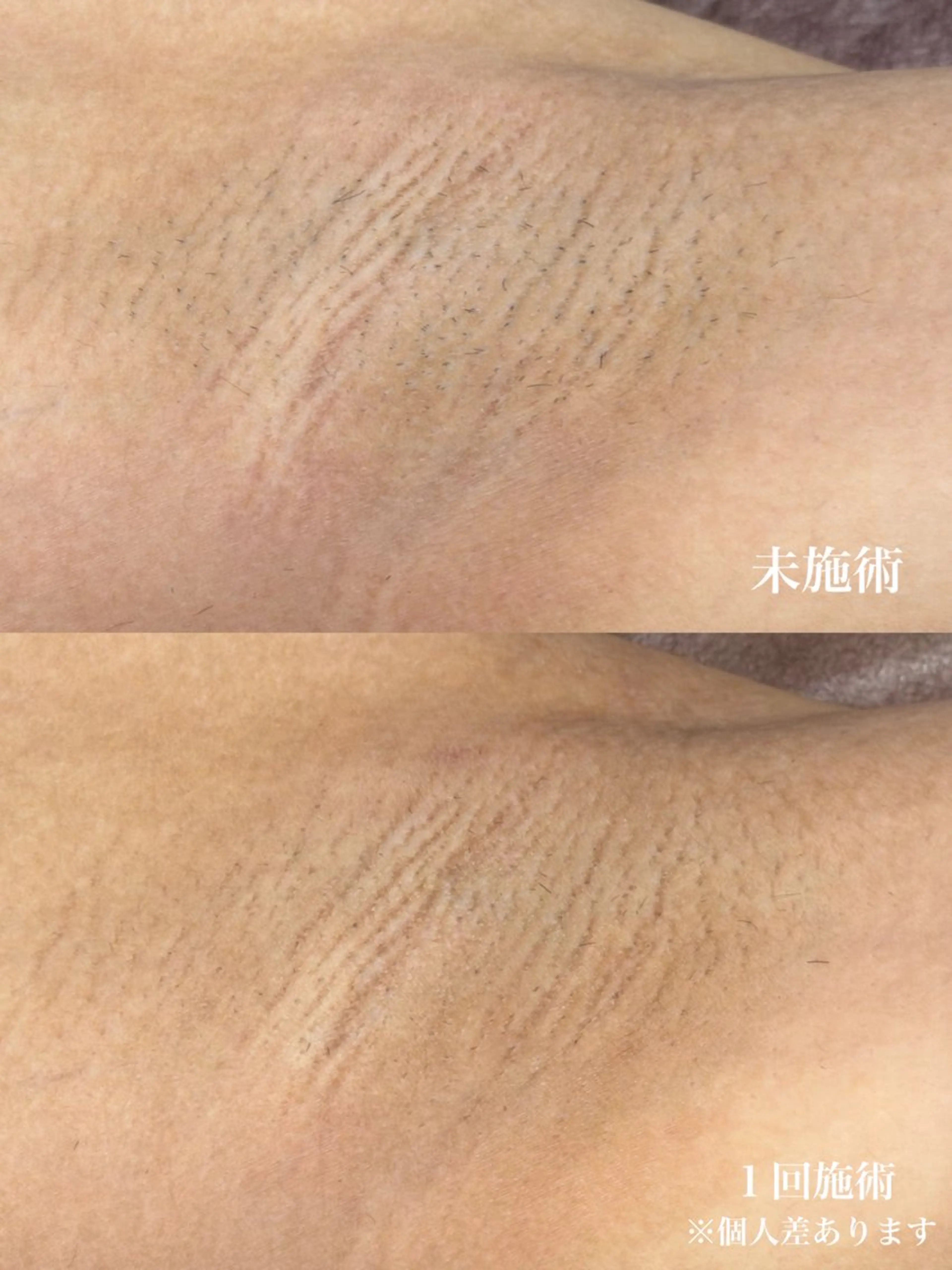 脱毛 muumo まりののエステ・リラクイメージ